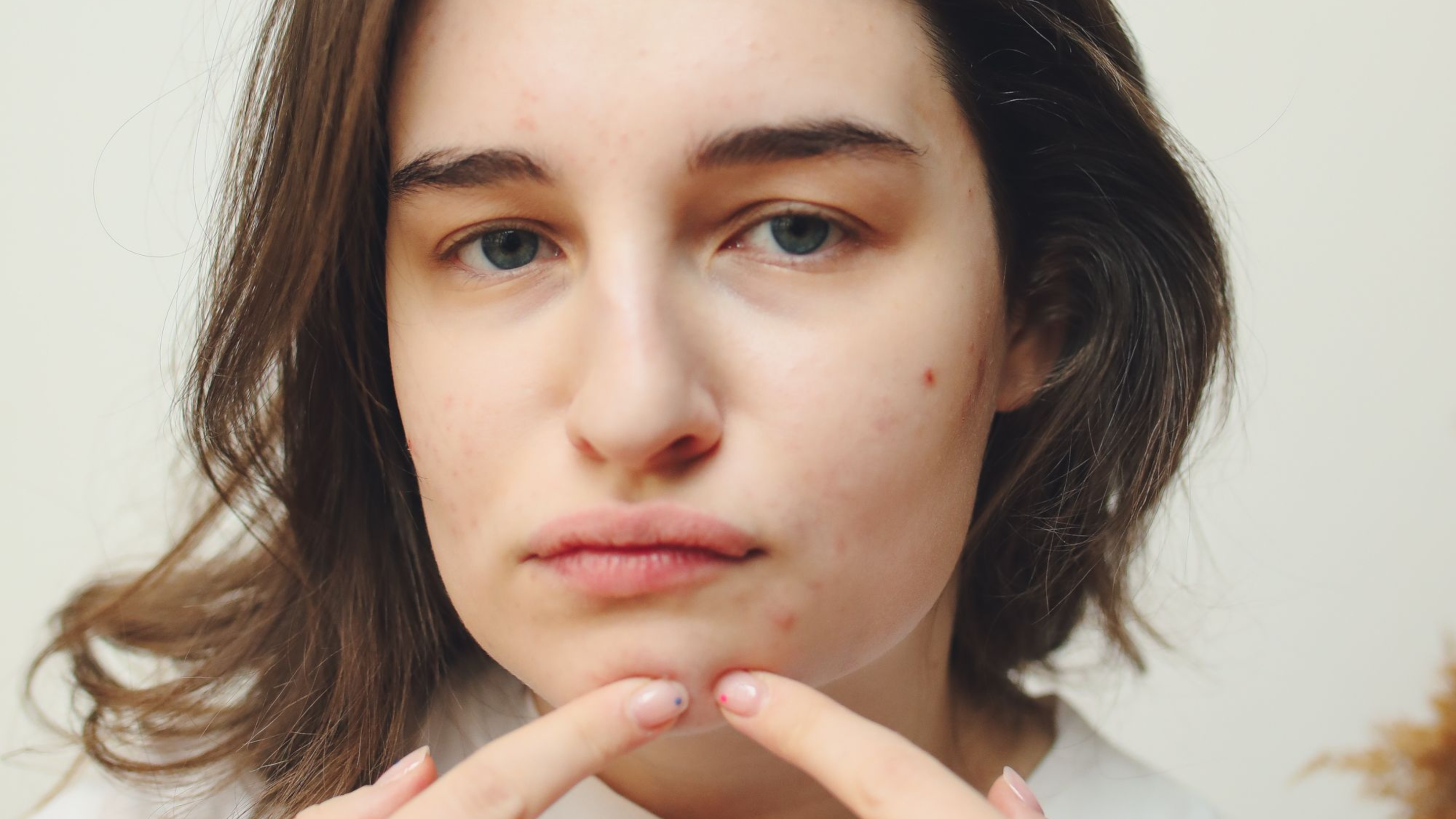 How to Remove Pimples From Face with Effective Treatments