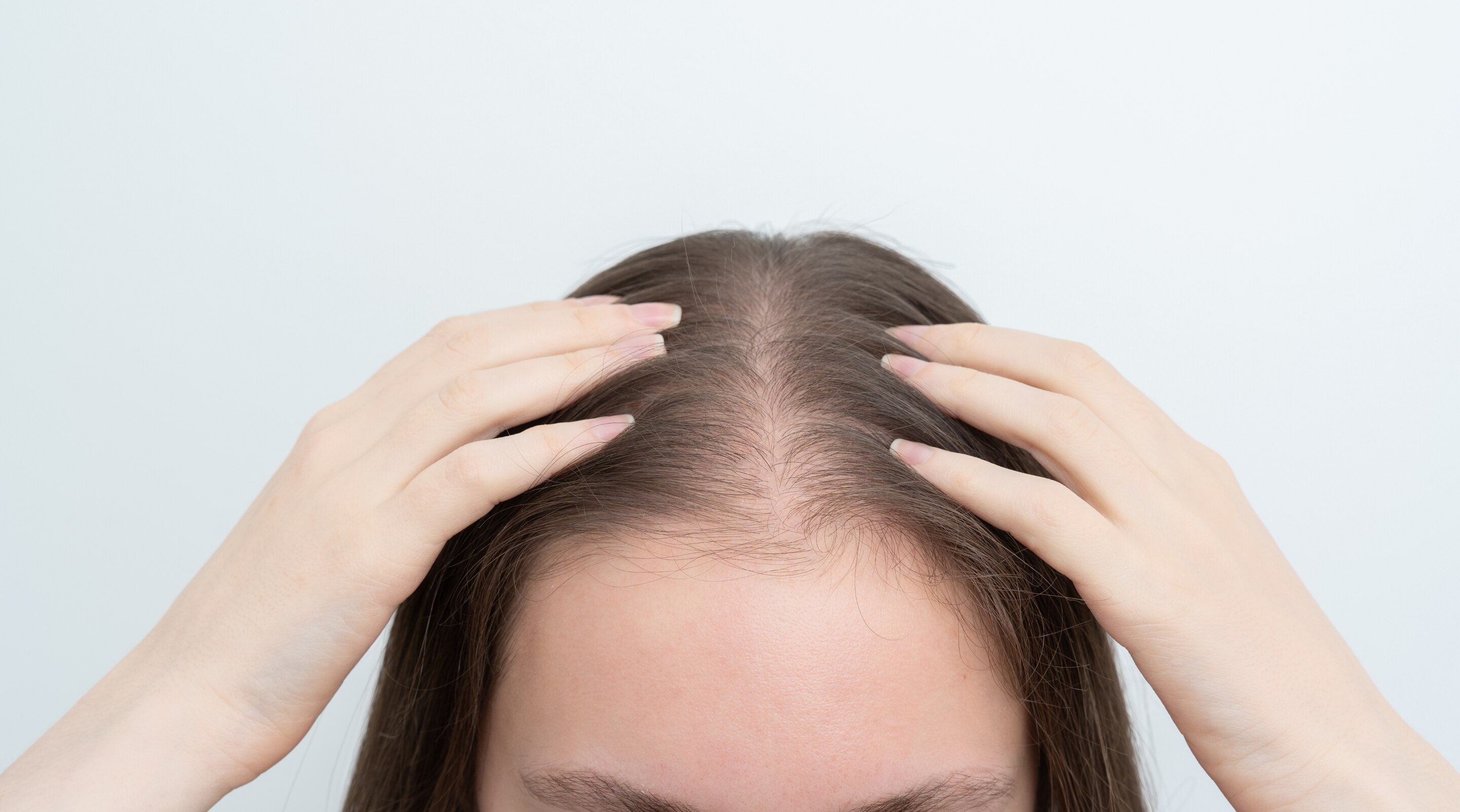 Receding Hairline Causes Stages and Treatment Options