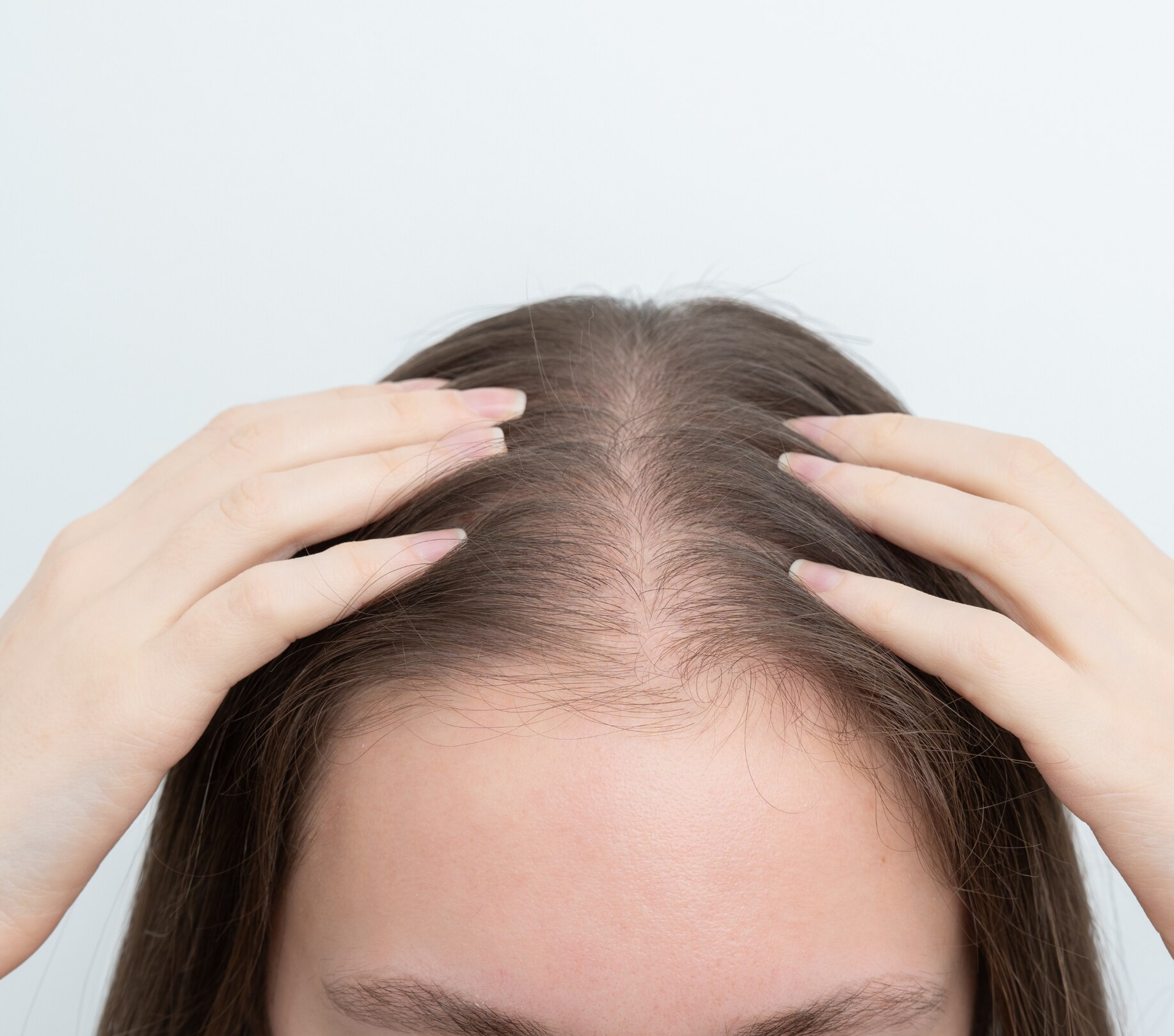 Image of Receding Hairline: Causes, Stages & Treatment Options for Healthier Hair