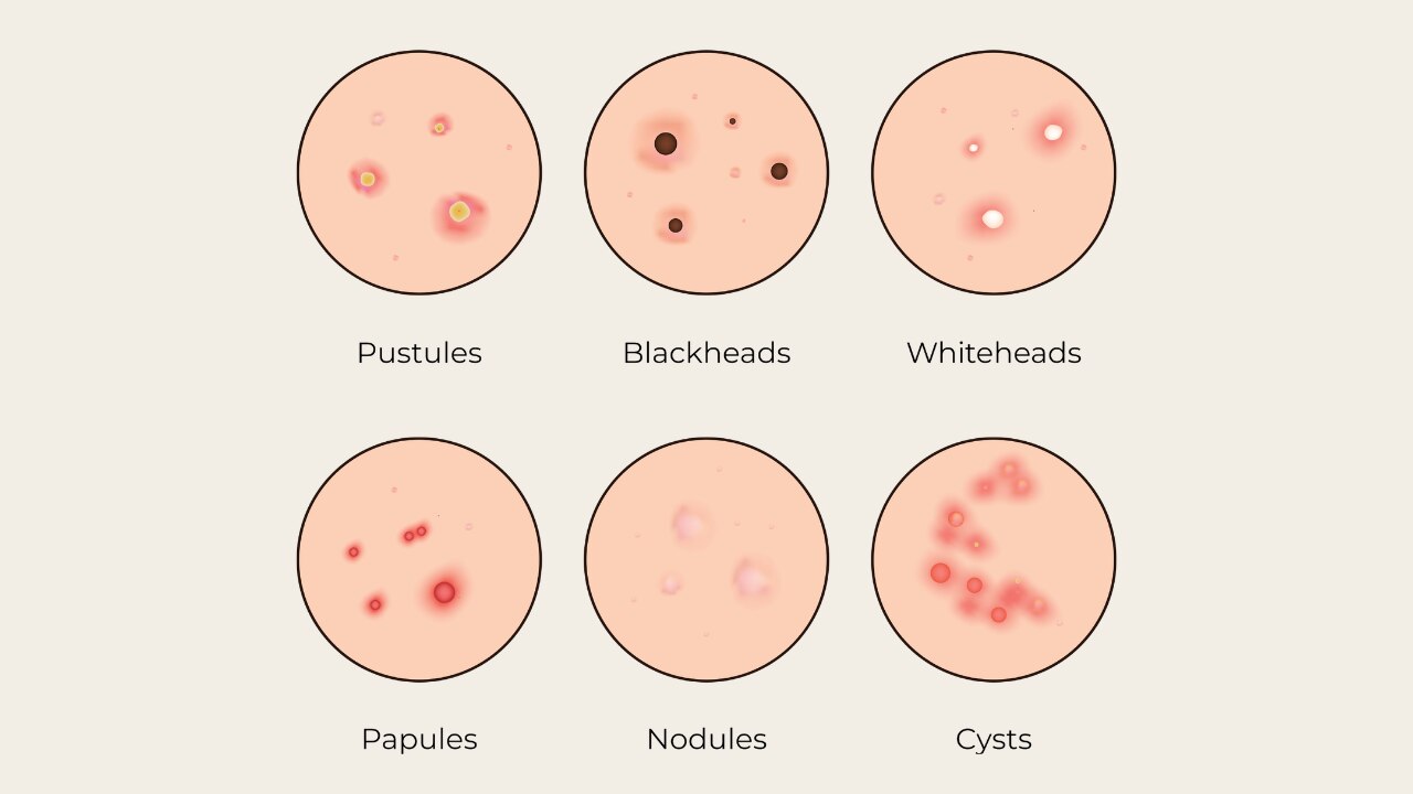 Types of Pimples