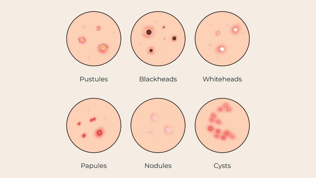 Types of Pimples