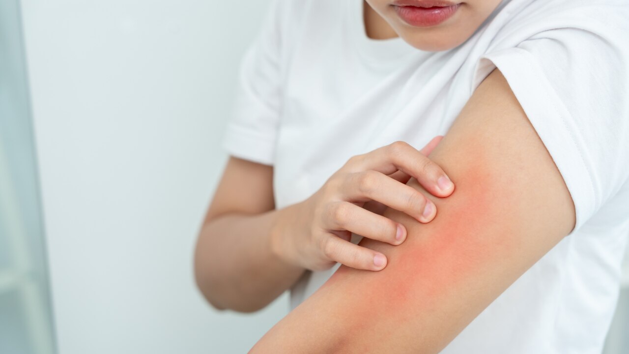 Allergic reactions