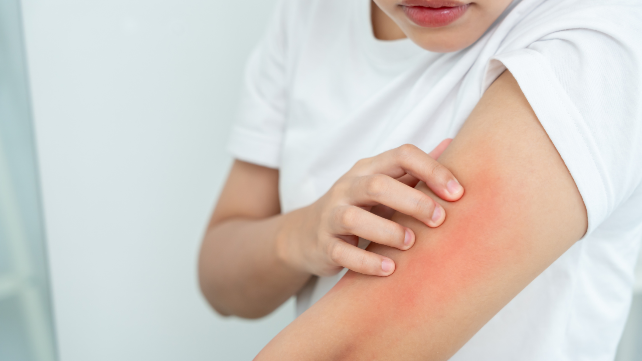 Allergic reactions