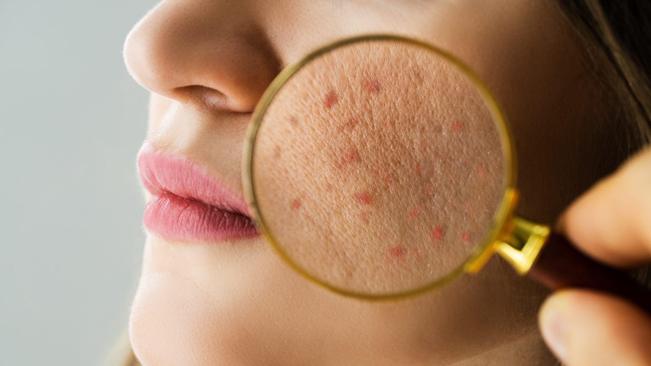 For Acne-Prone Skin