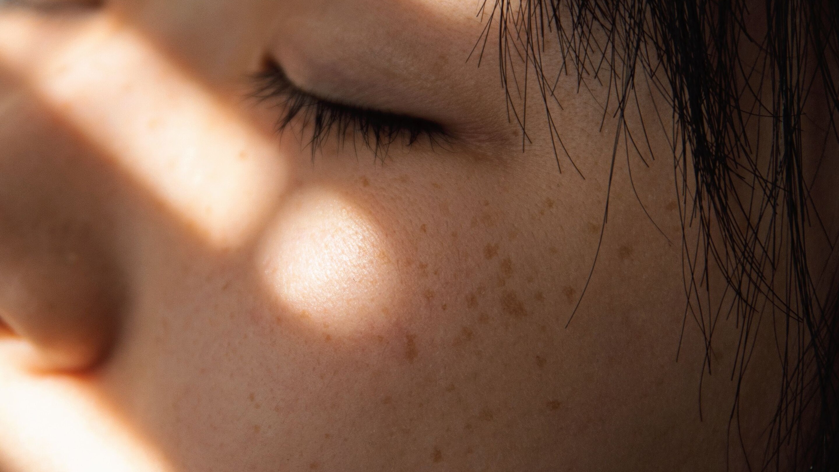 Hyperpigmentation