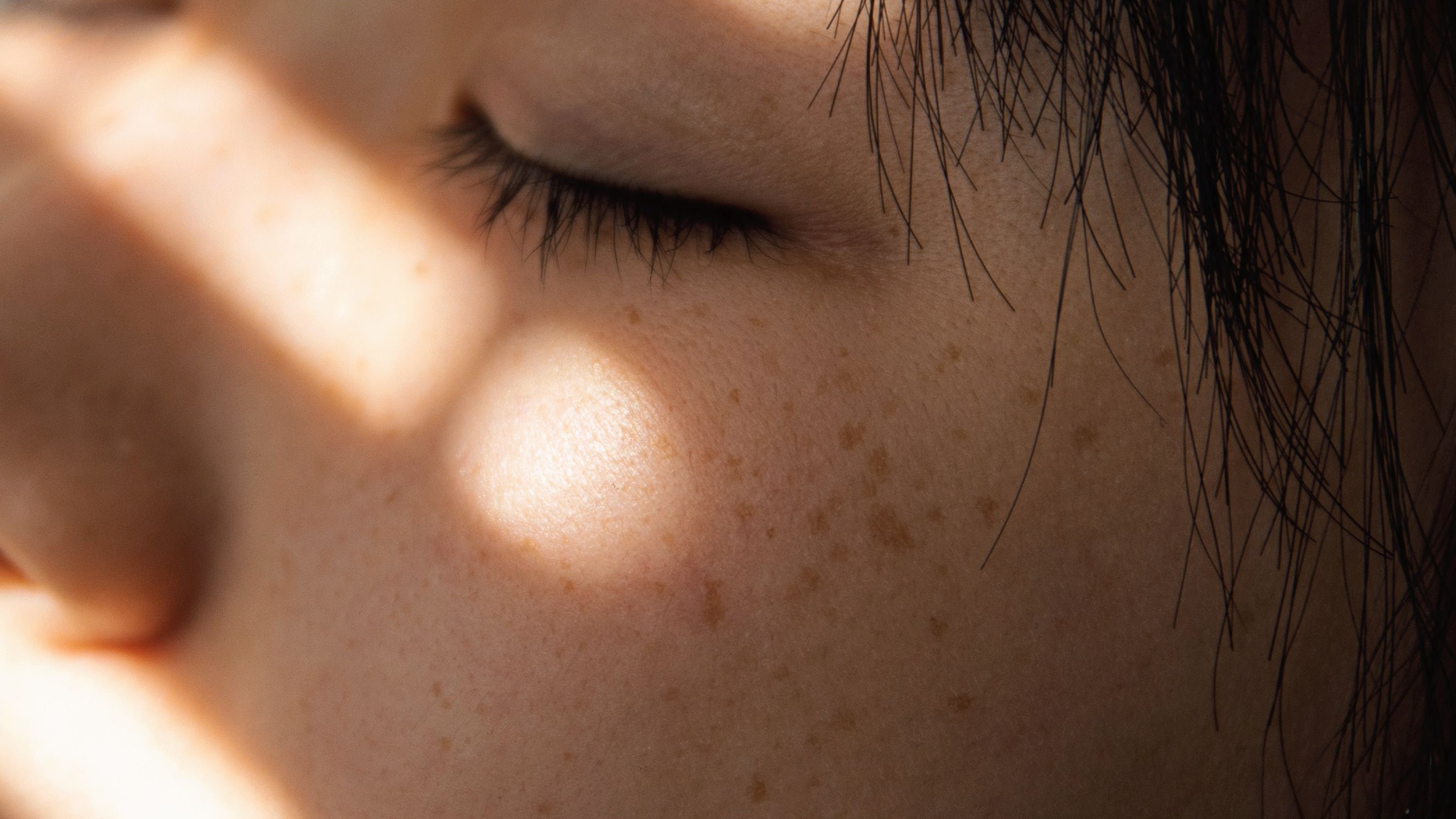 Hyperpigmentation