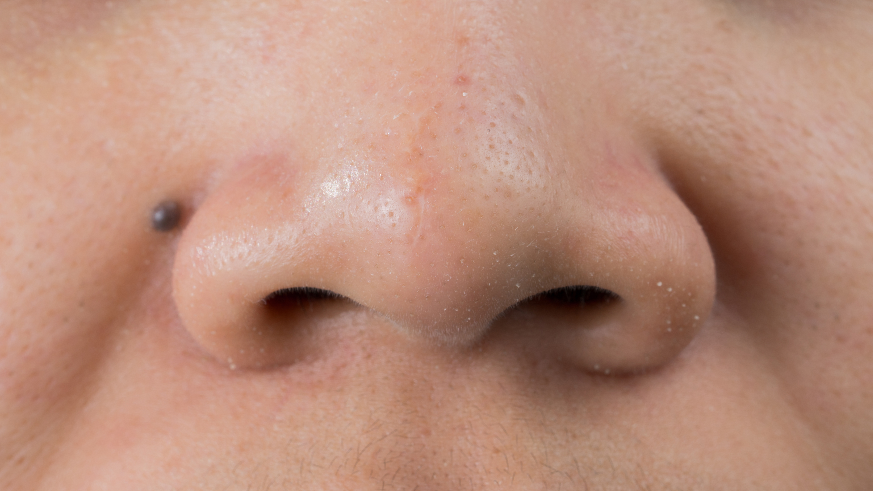 What Are Whiteheads on the Nose?