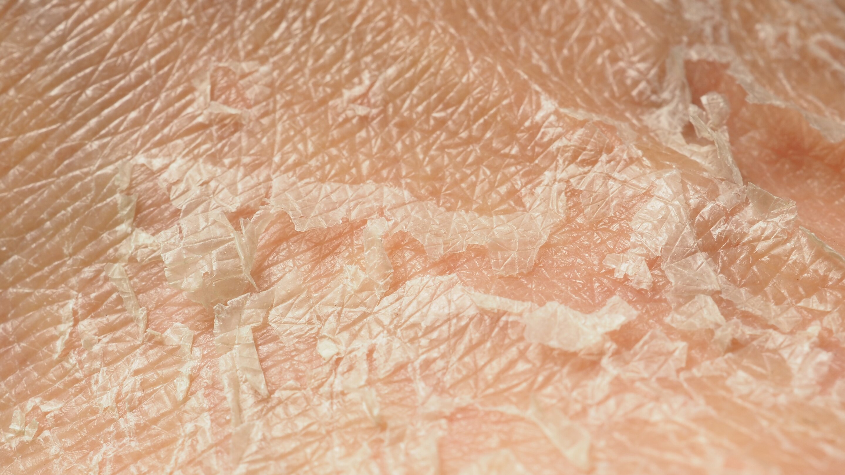 Dead skin cell build-up