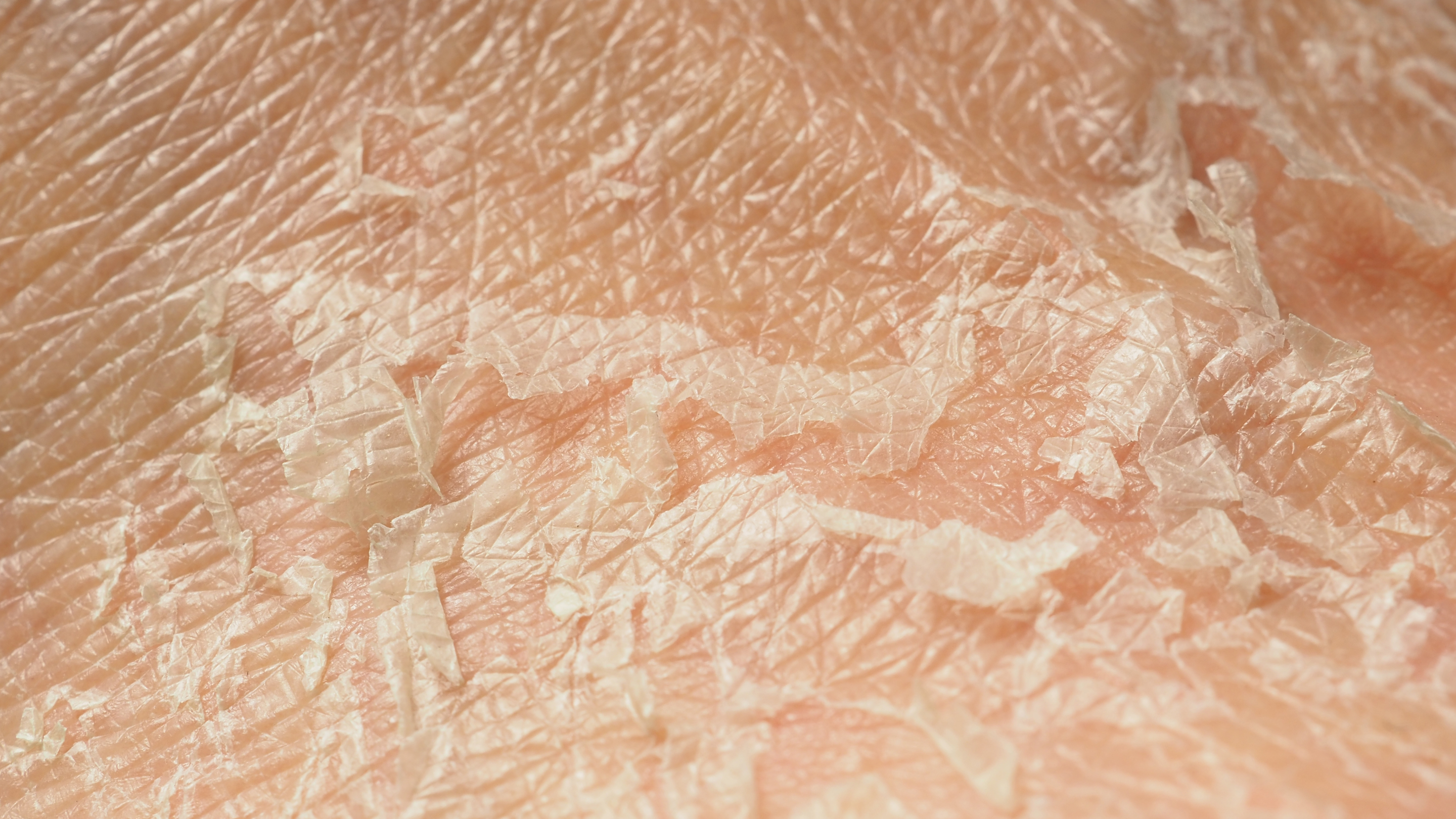 Dead skin cell build-up