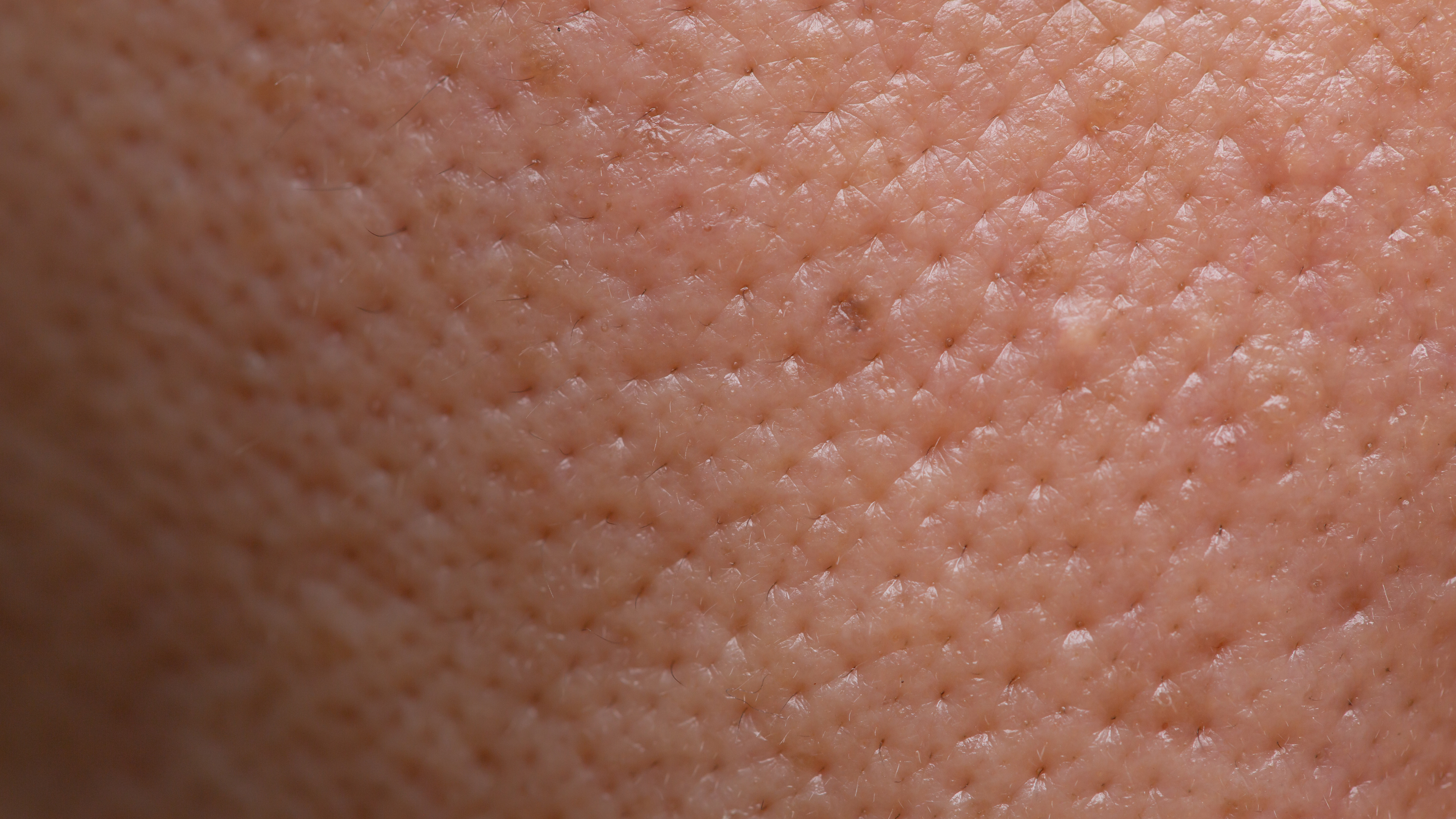Clogged pores