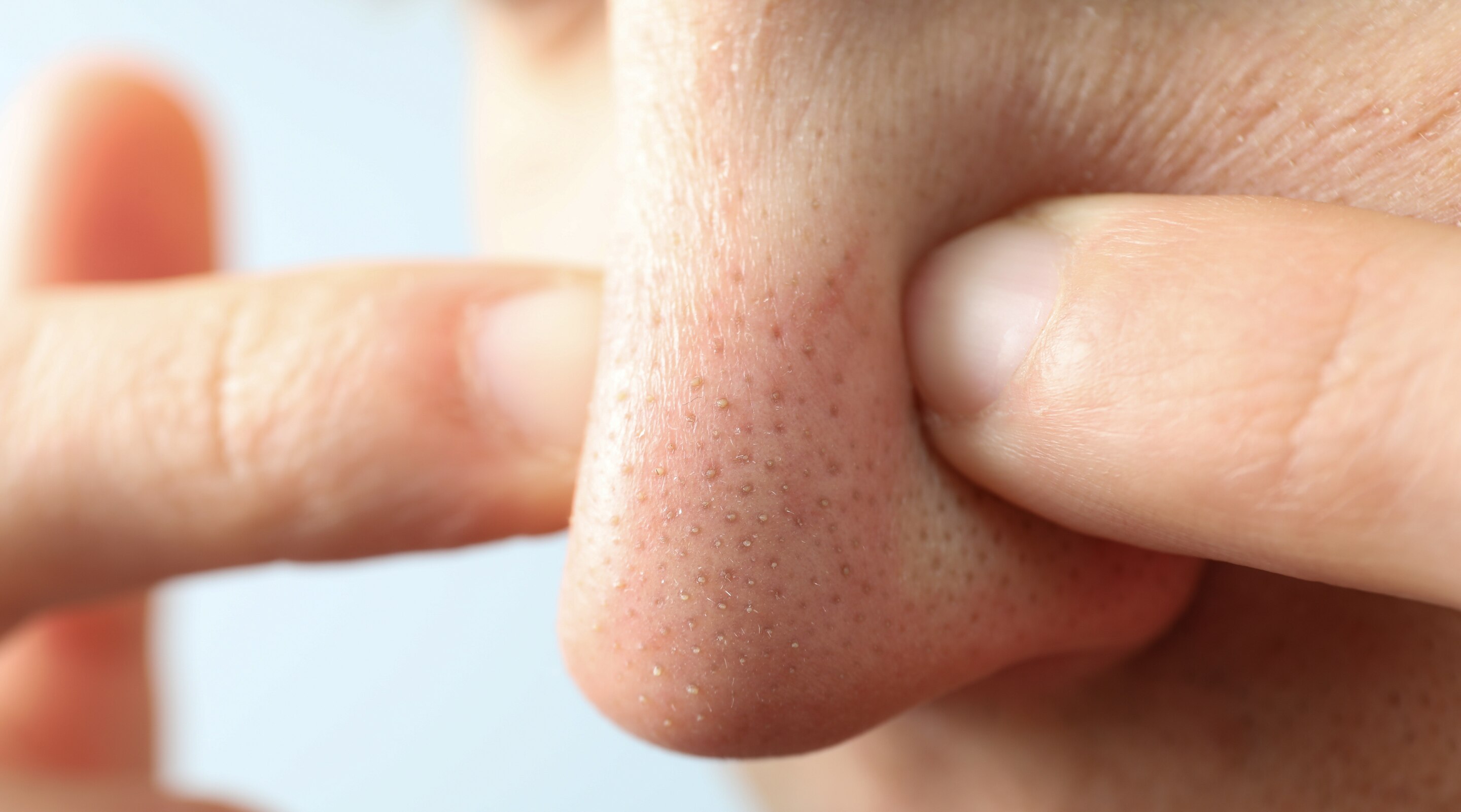 Whiteheads on Nose Causes and Treatment Options