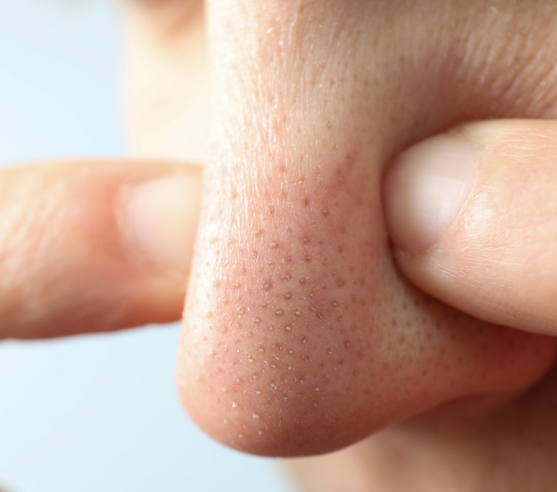 Image of Whiteheads on Nose: Causes, Treatment & How to Get Rid of Them