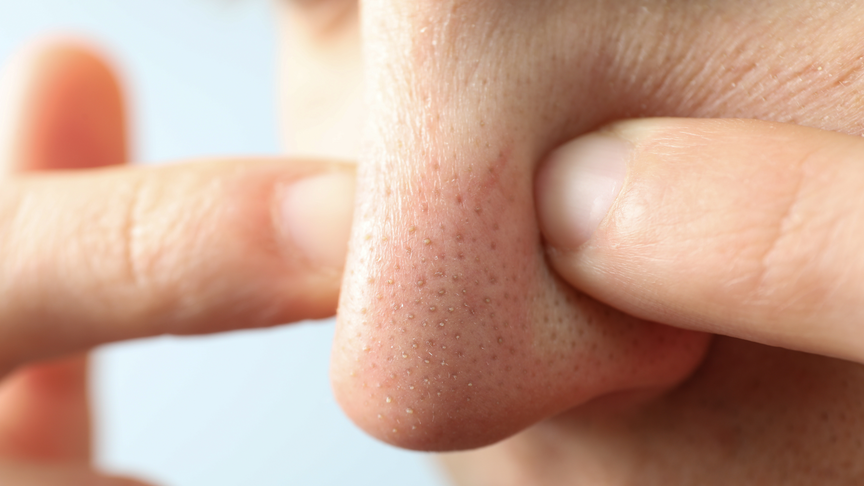 Whiteheads on Nose Causes and Treatment Options