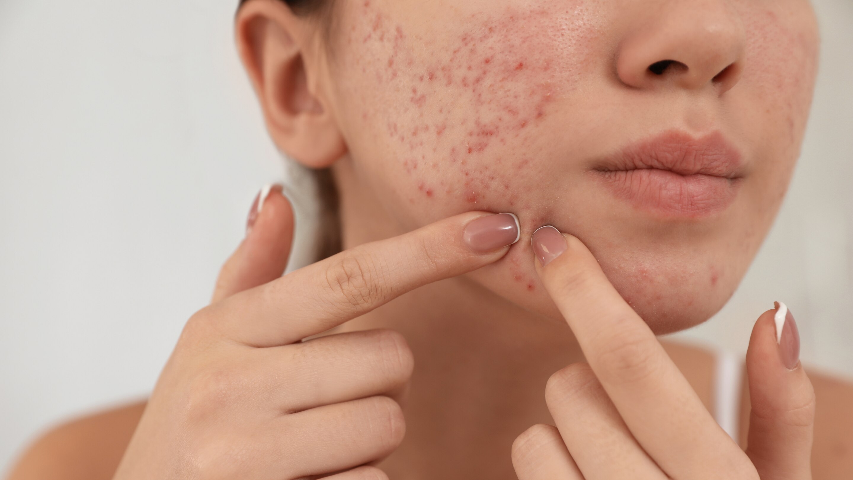 Oily and Acne-Prone Skin