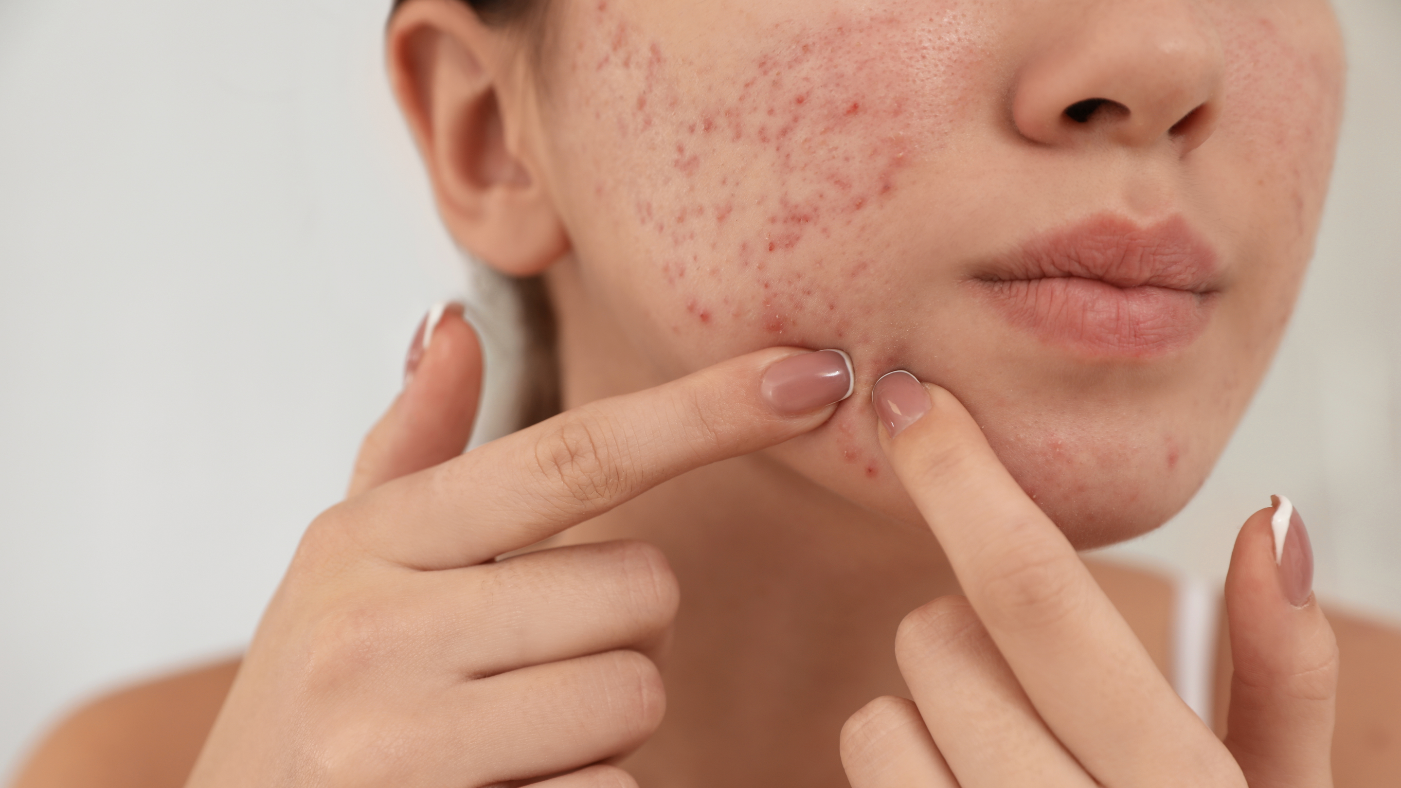 Oily and Acne-Prone Skin