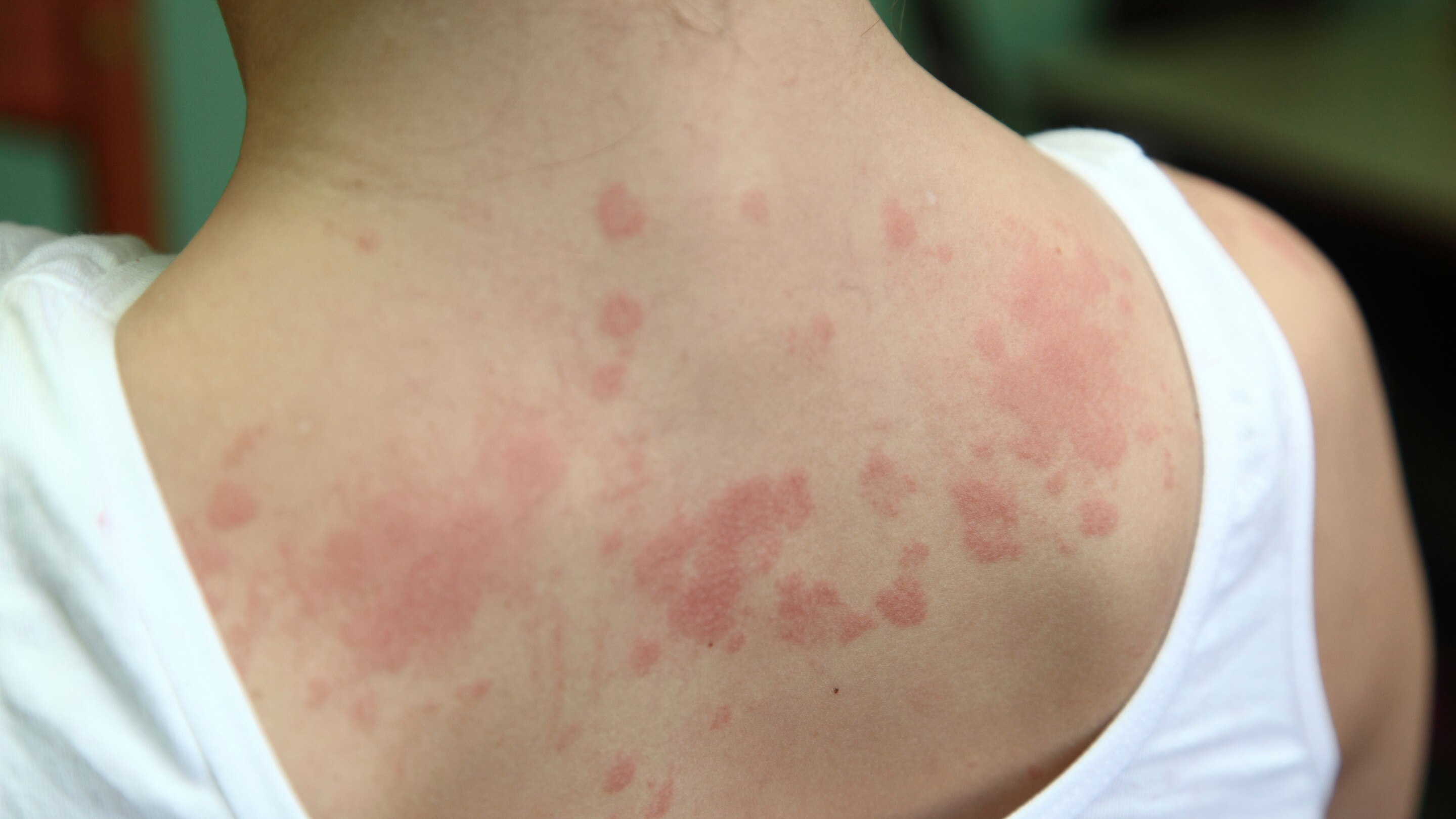Contact dermatitis.