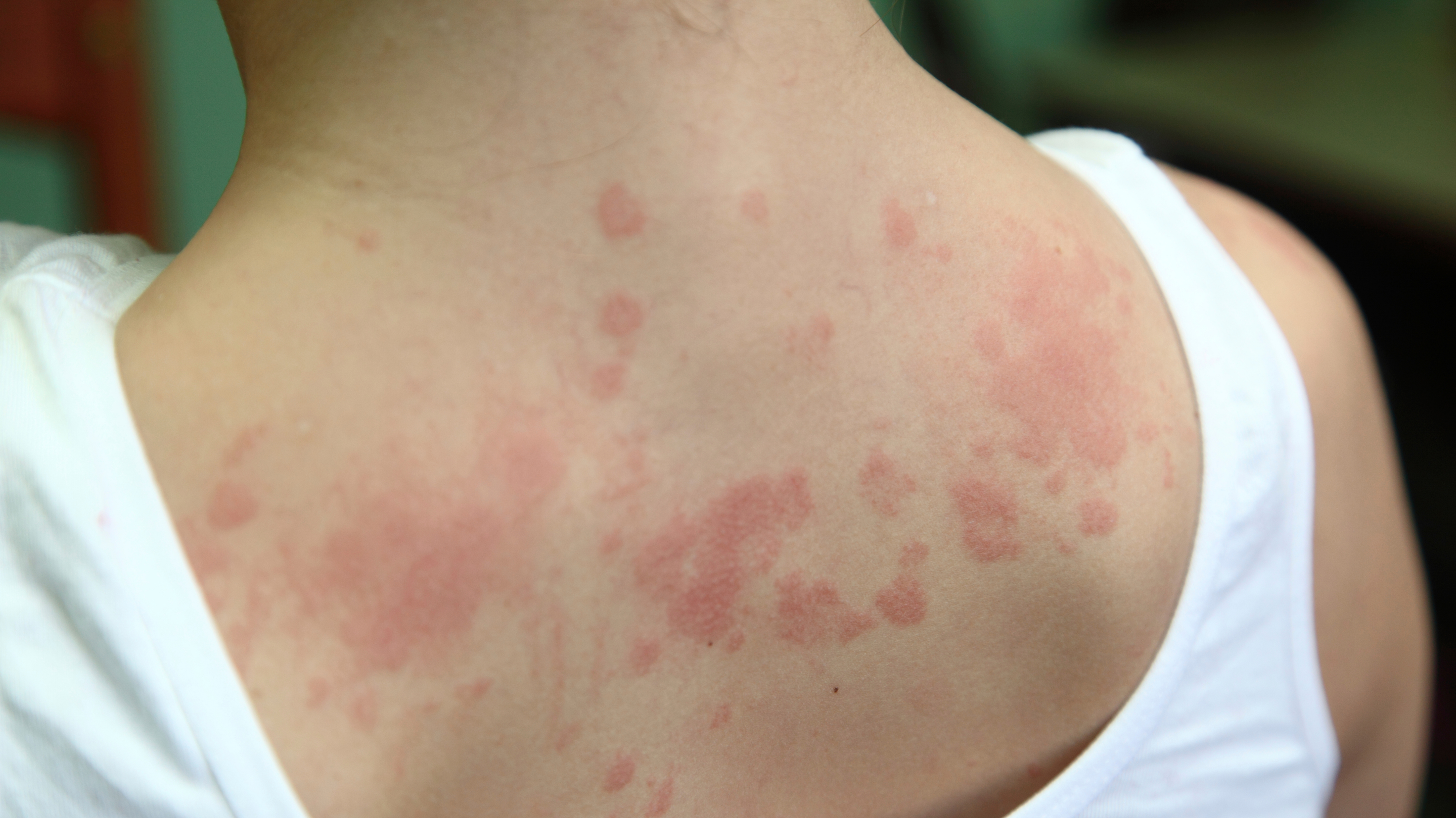 Contact dermatitis.