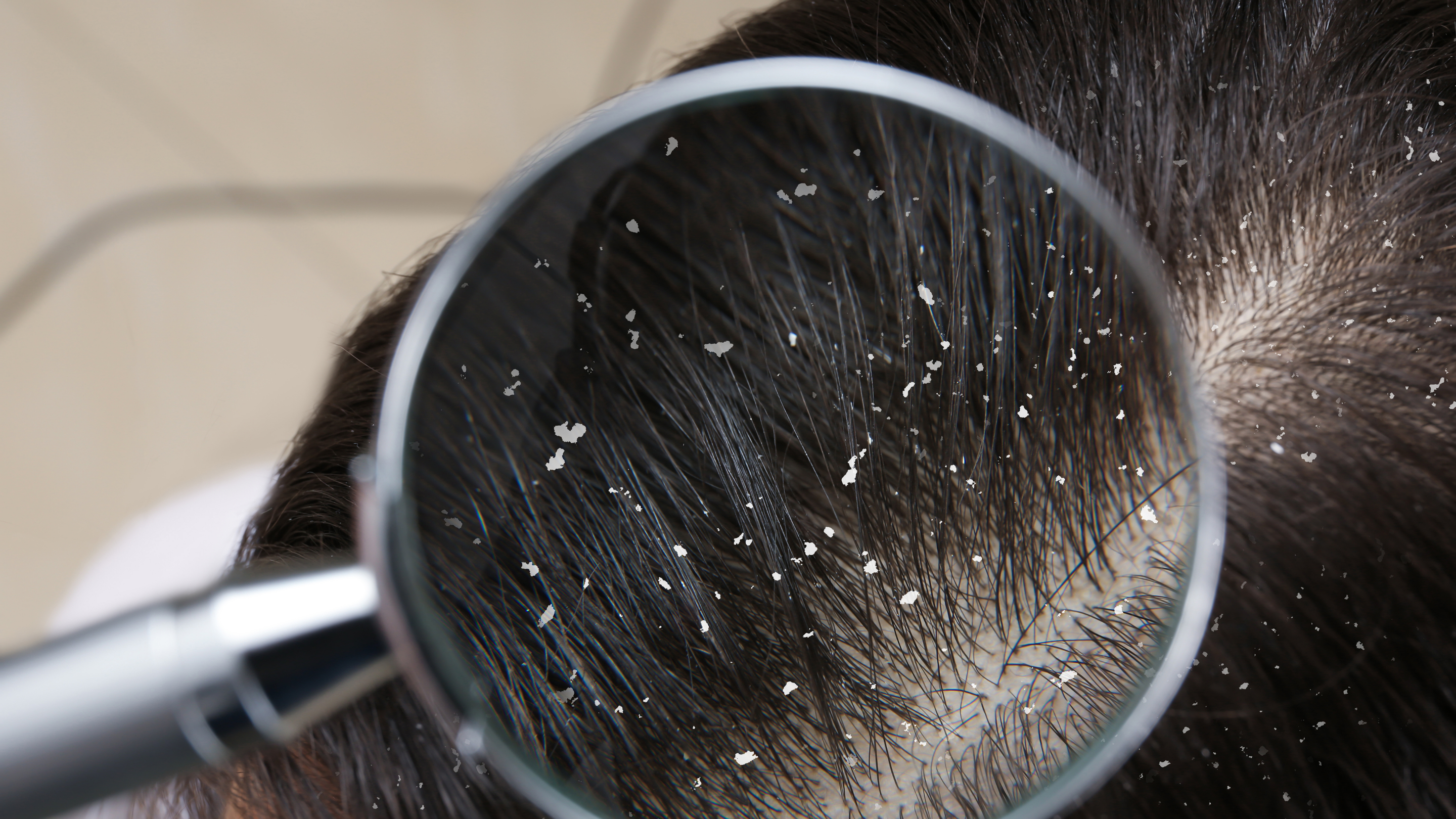 Dandruff (seborrhoeic dermatitis).