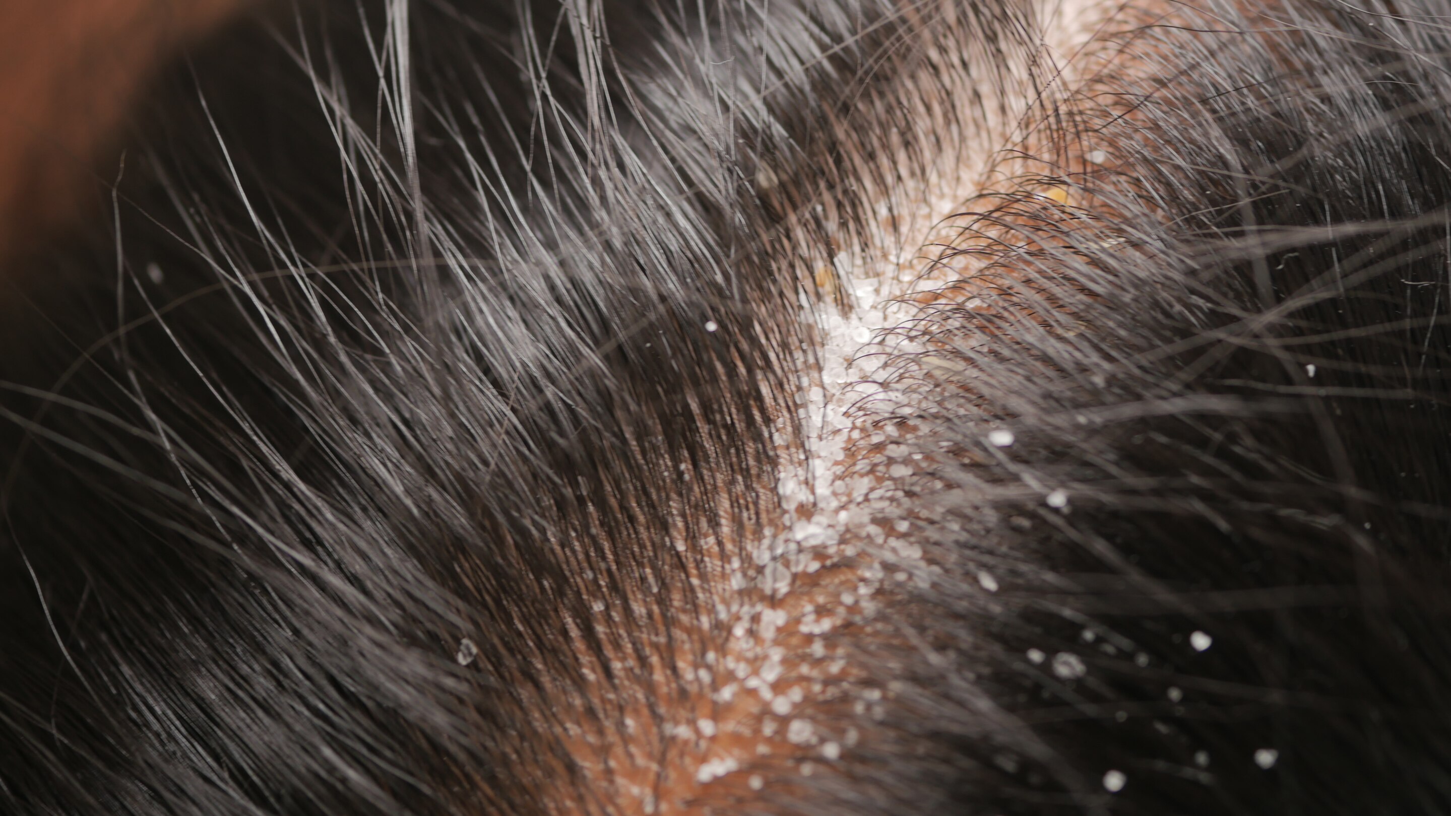 Dry scalp.