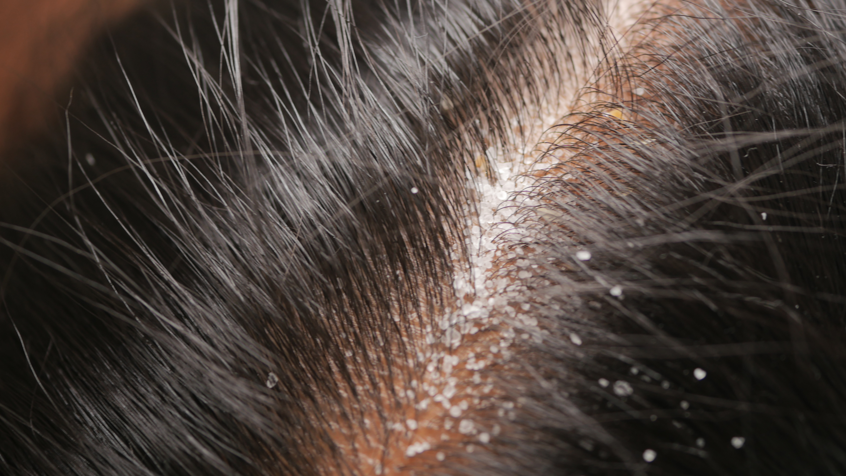 Dry scalp.