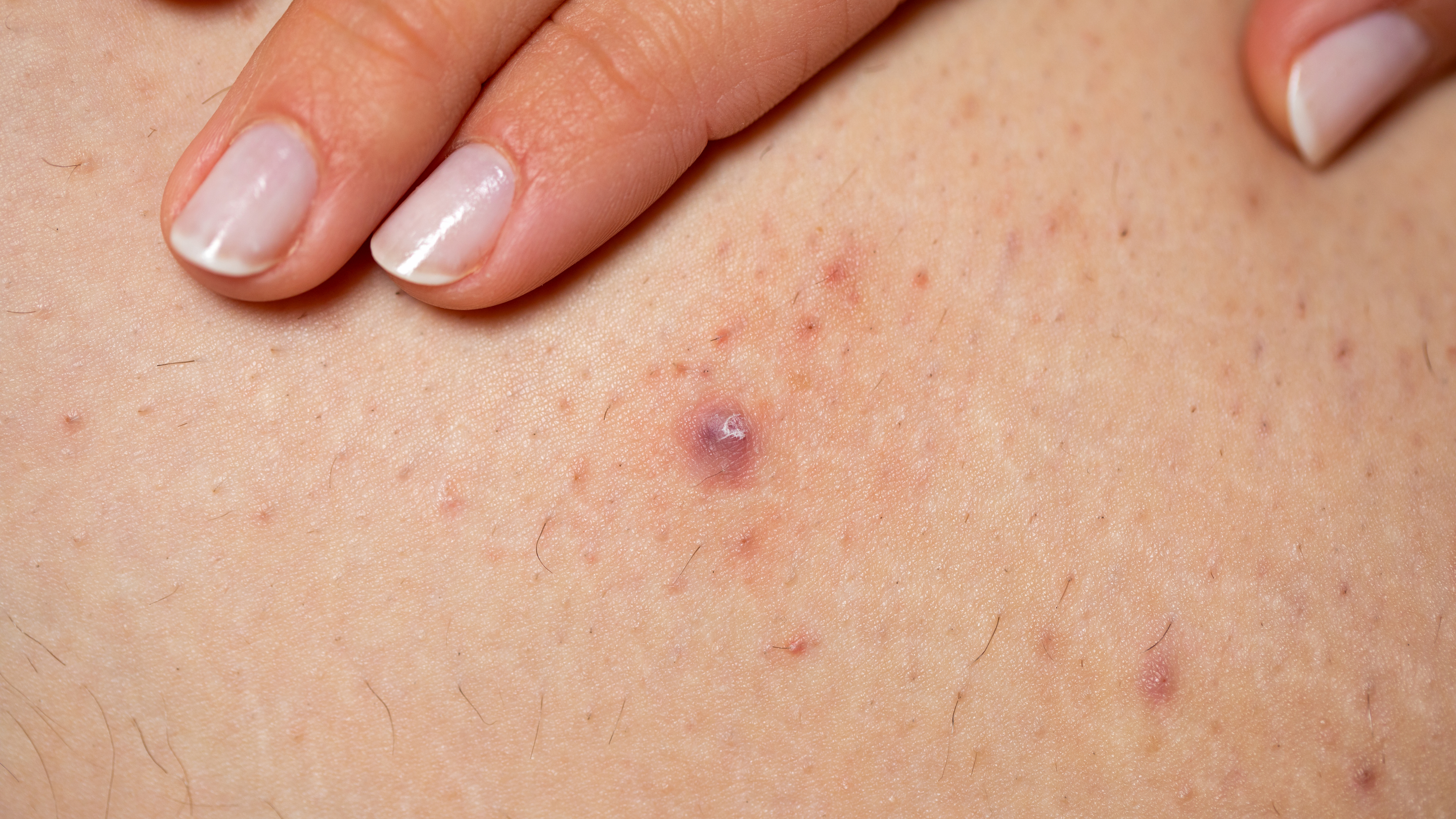 Folliculitis.