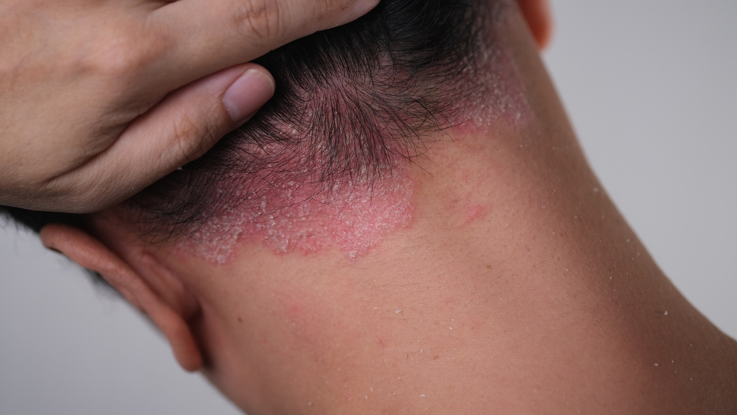 Psoriasis.