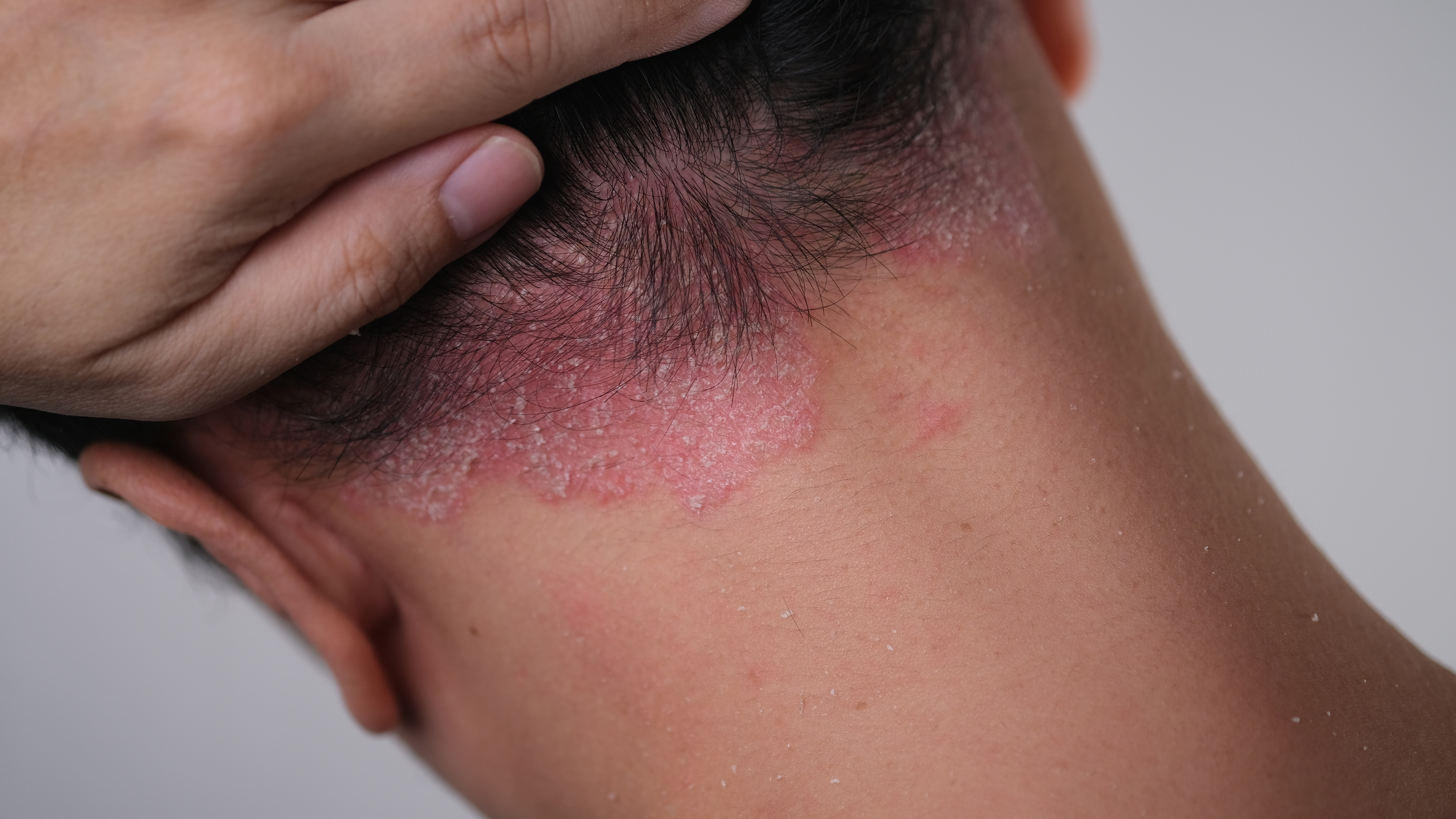 Psoriasis.