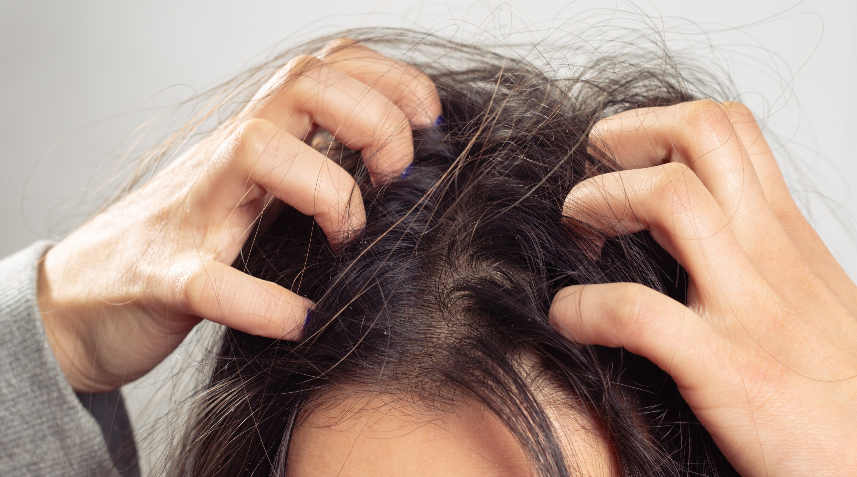 Itchy Scalp Causes and Treatment for Relief