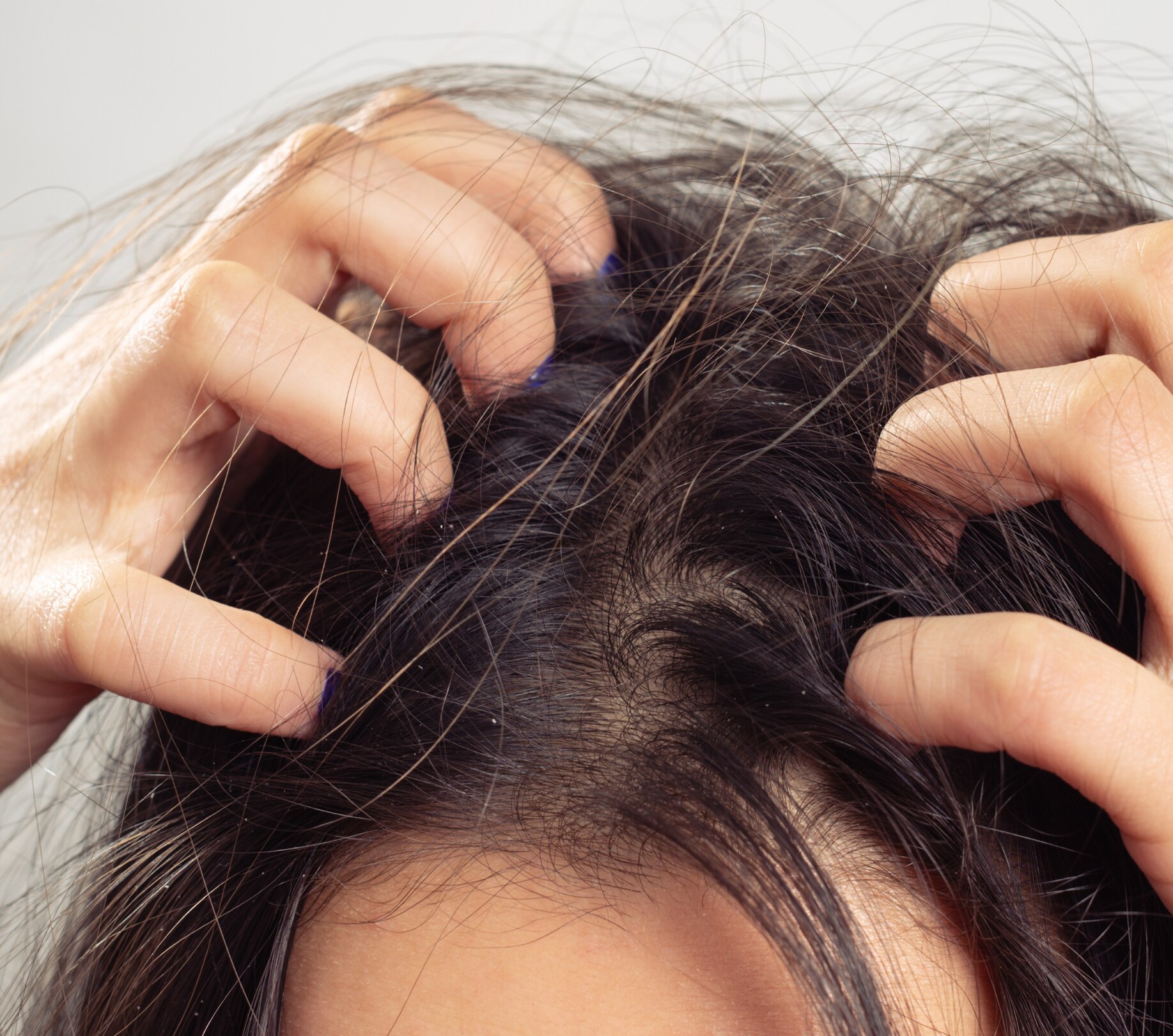 Image of Itchy Scalp: Causes, Treatment & How to Get Relief