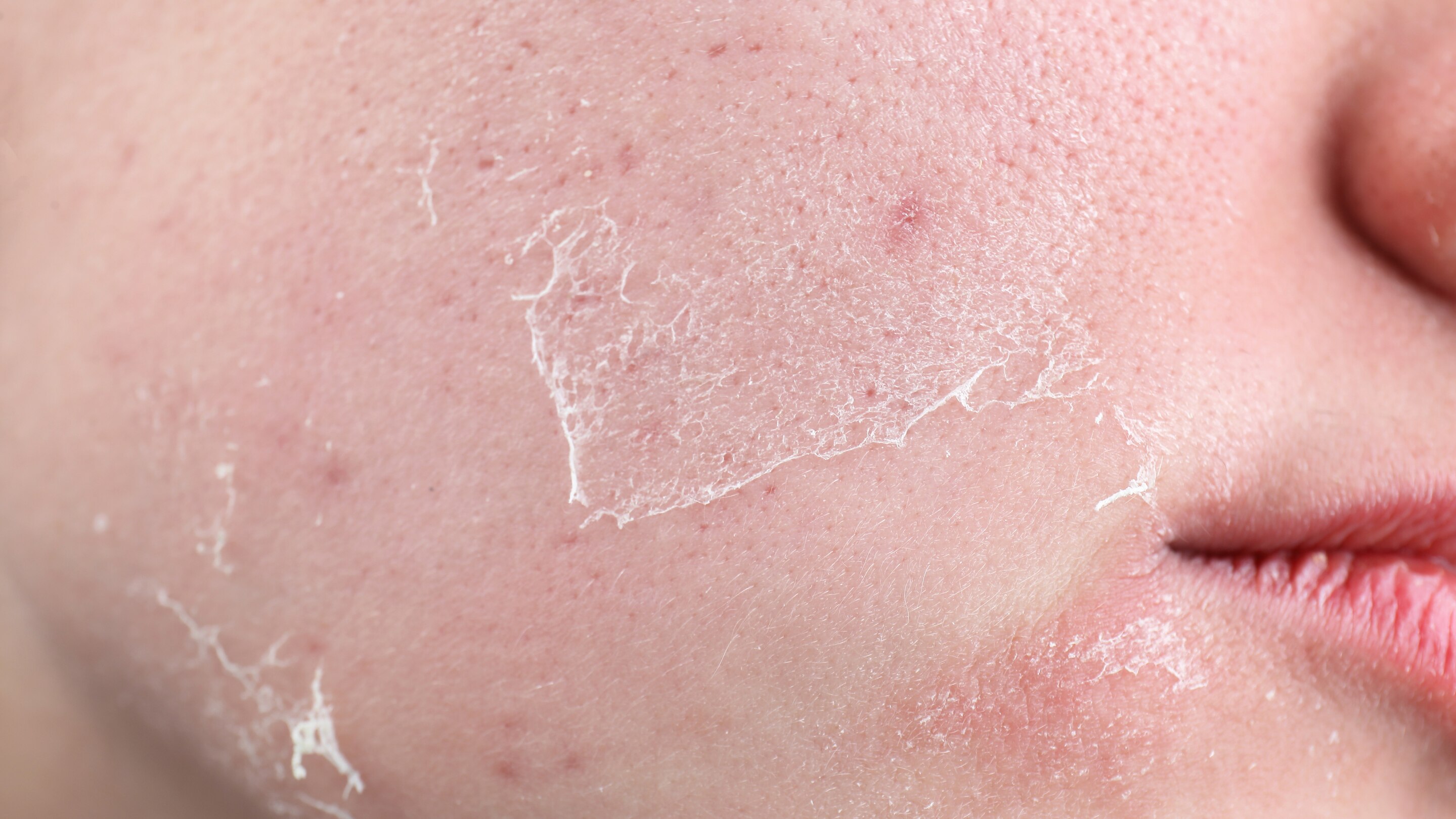 Sensitive Dry Skin
