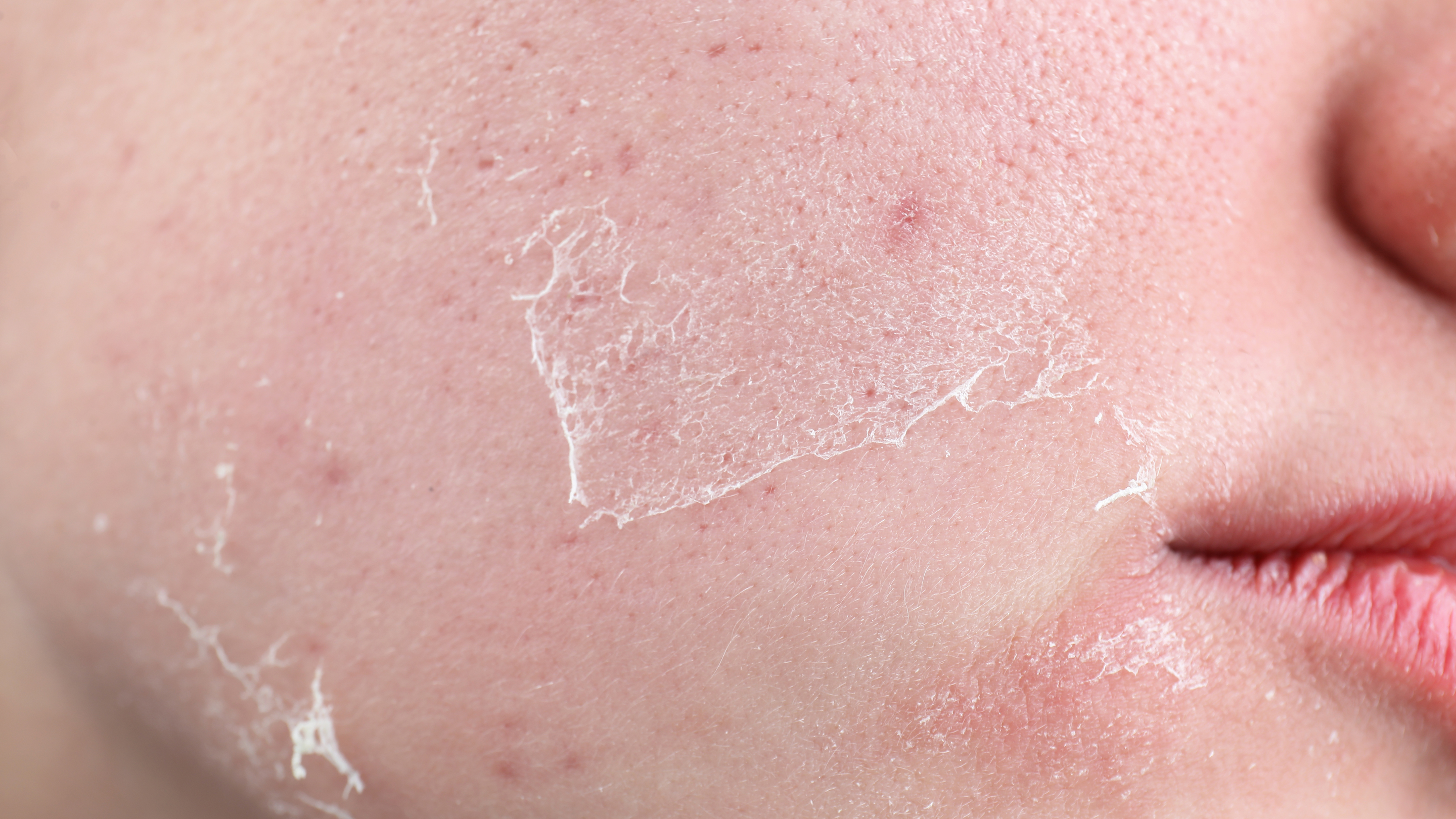 Sensitive Dry Skin