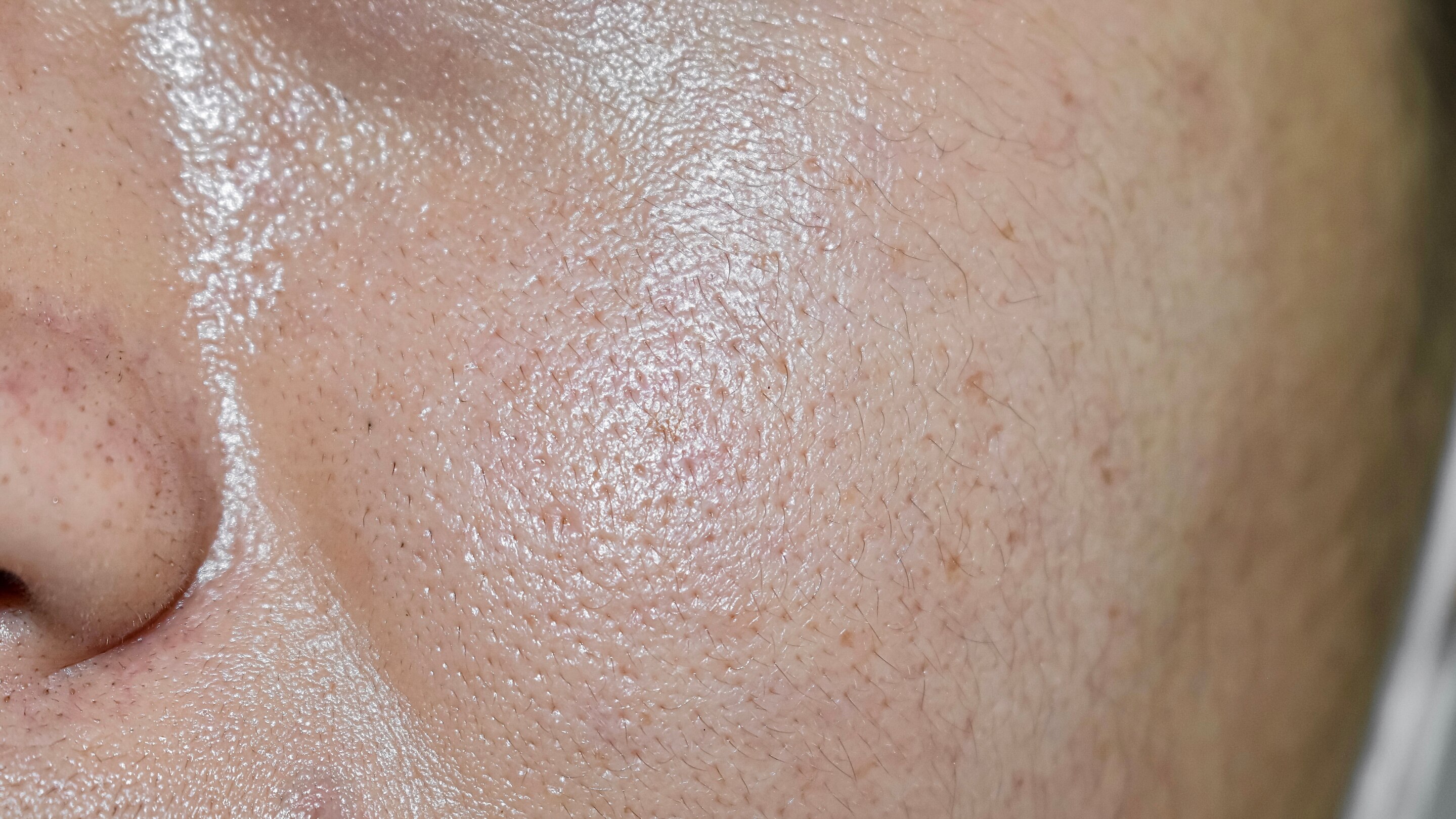 Sensitive Oily Skin