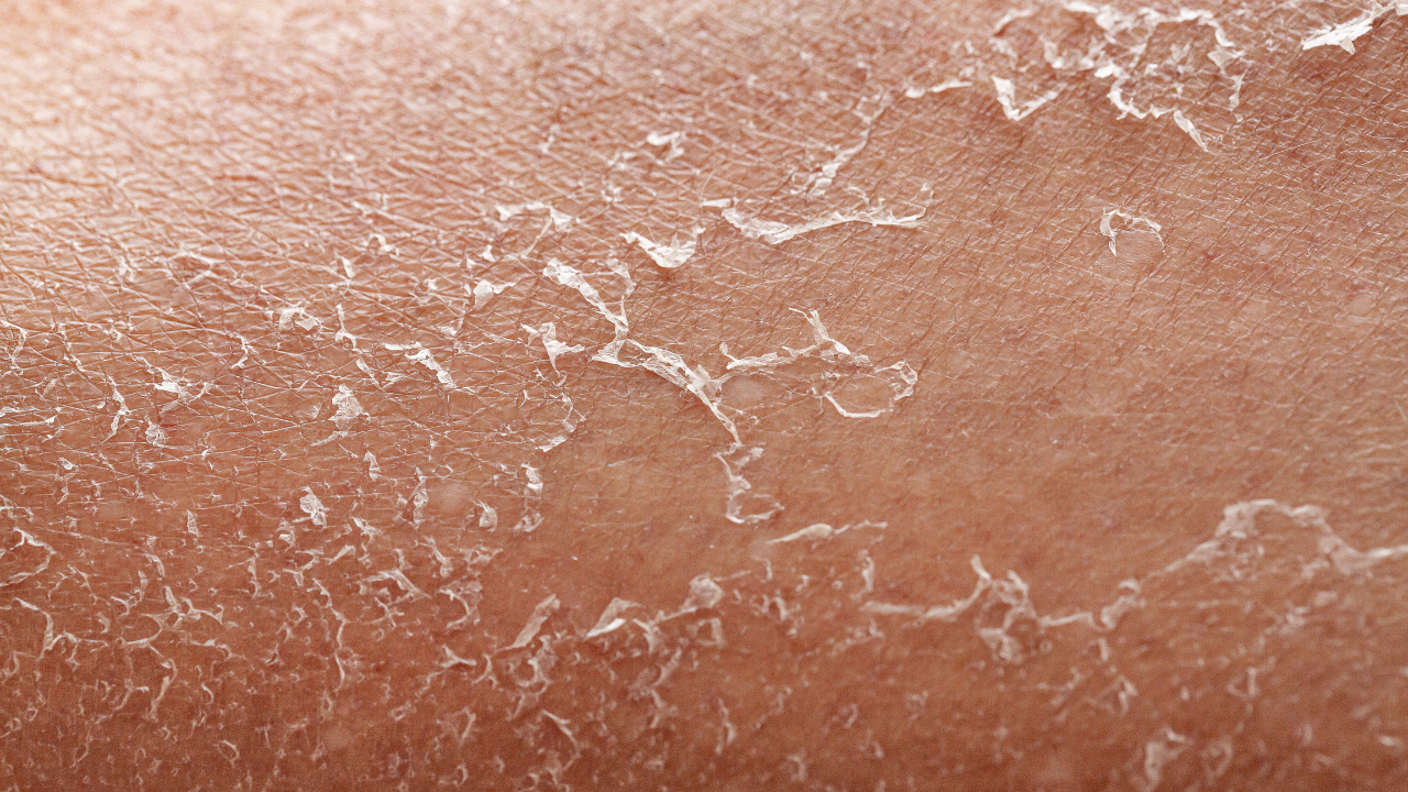 Relieves Dryness and Tightness