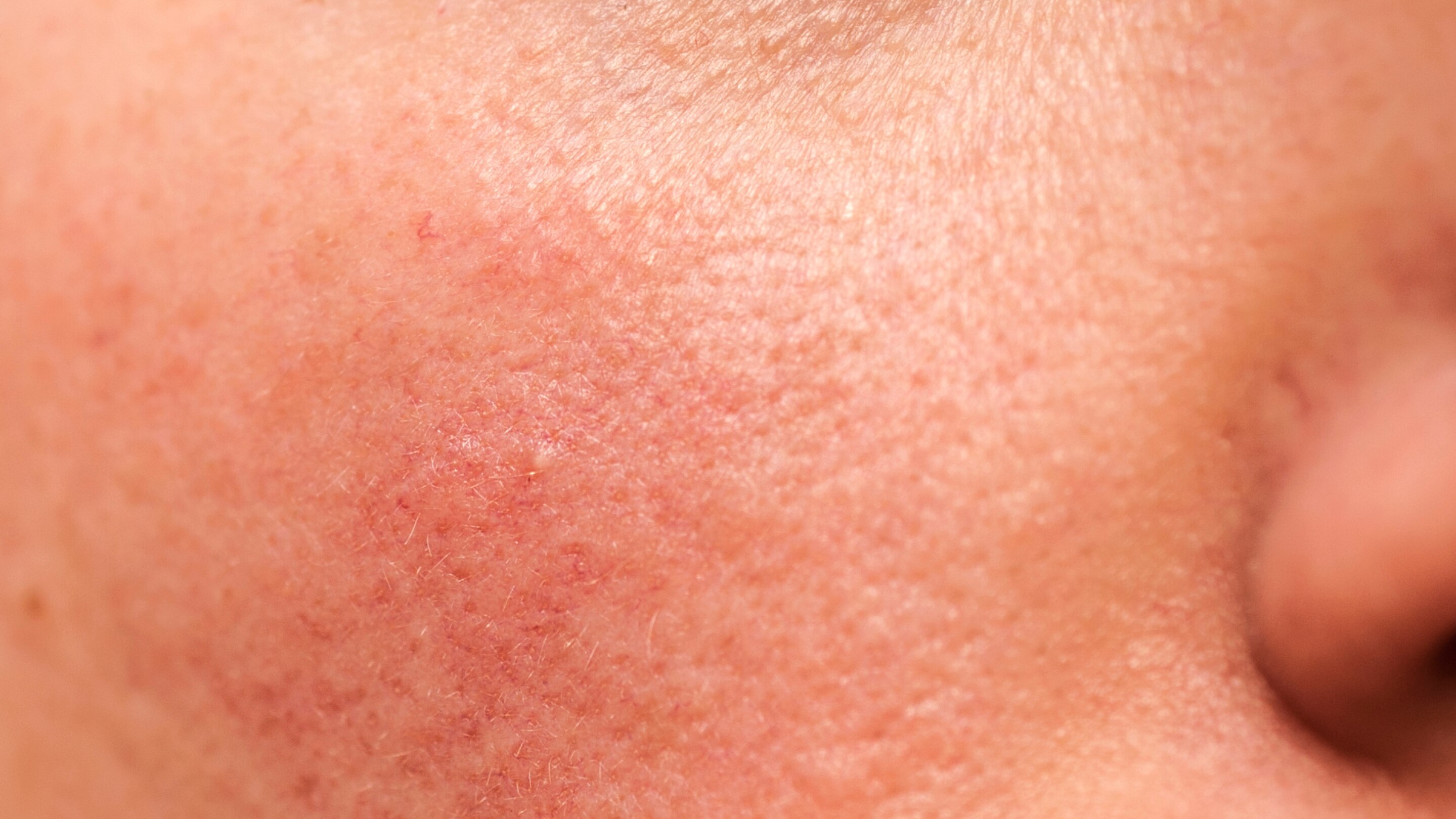 Uneven Skin Tone