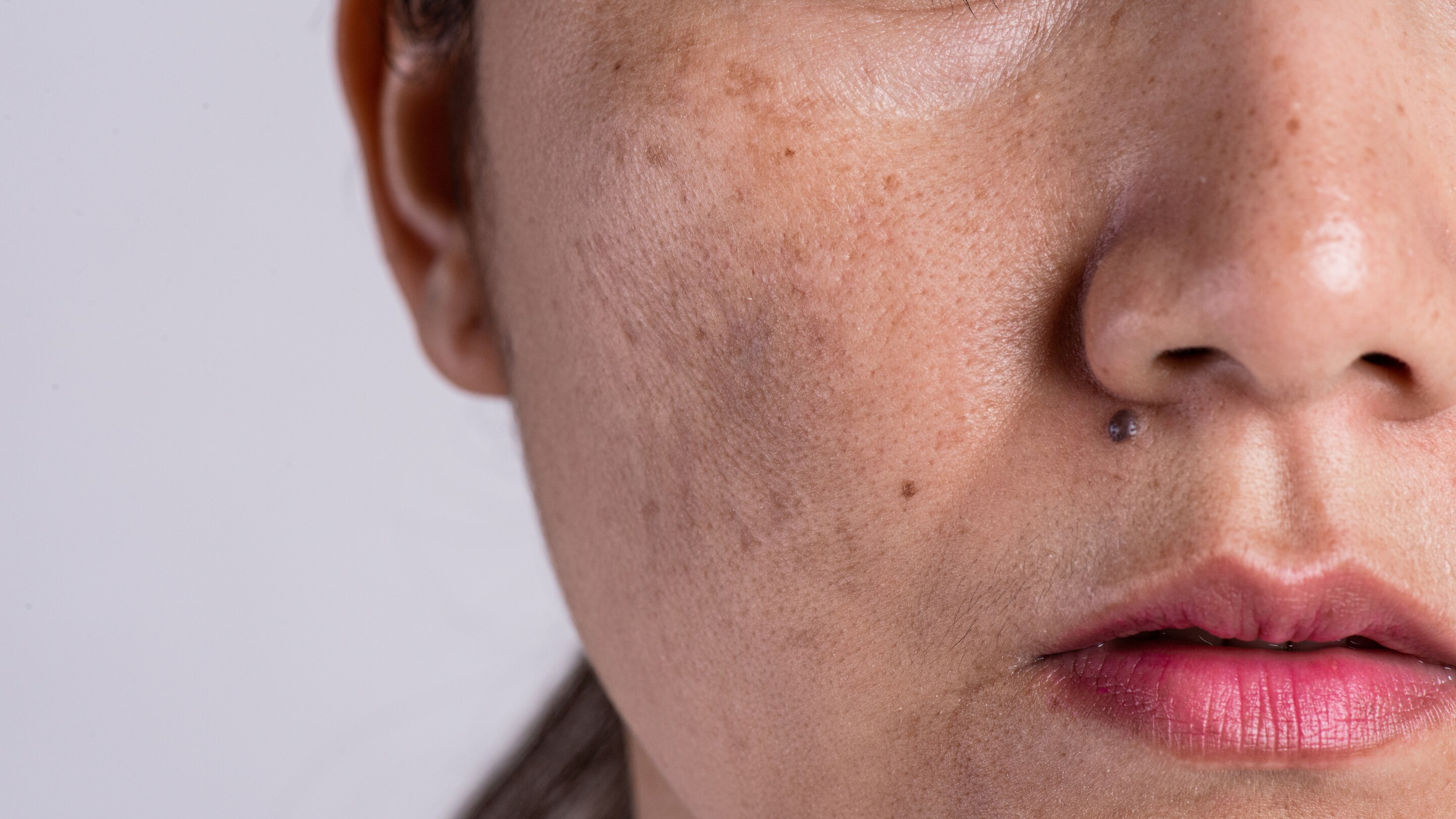 Dark Spots and Pigmentation