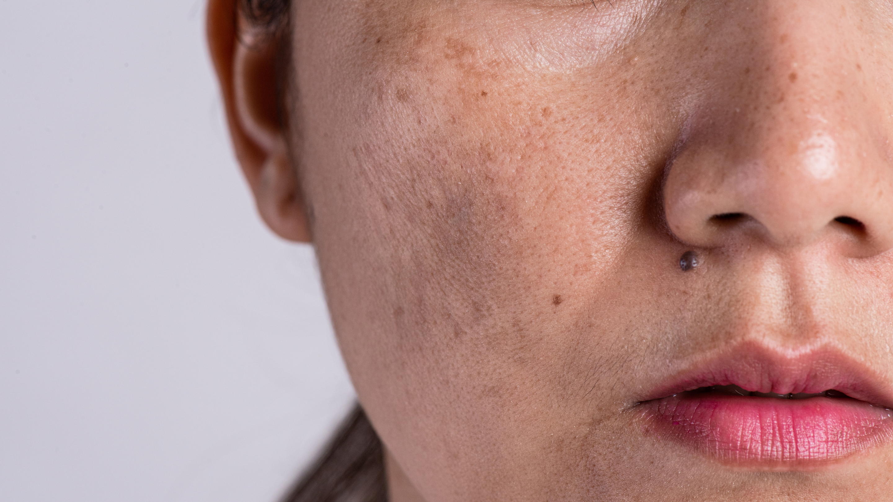Dark Spots and Pigmentation
