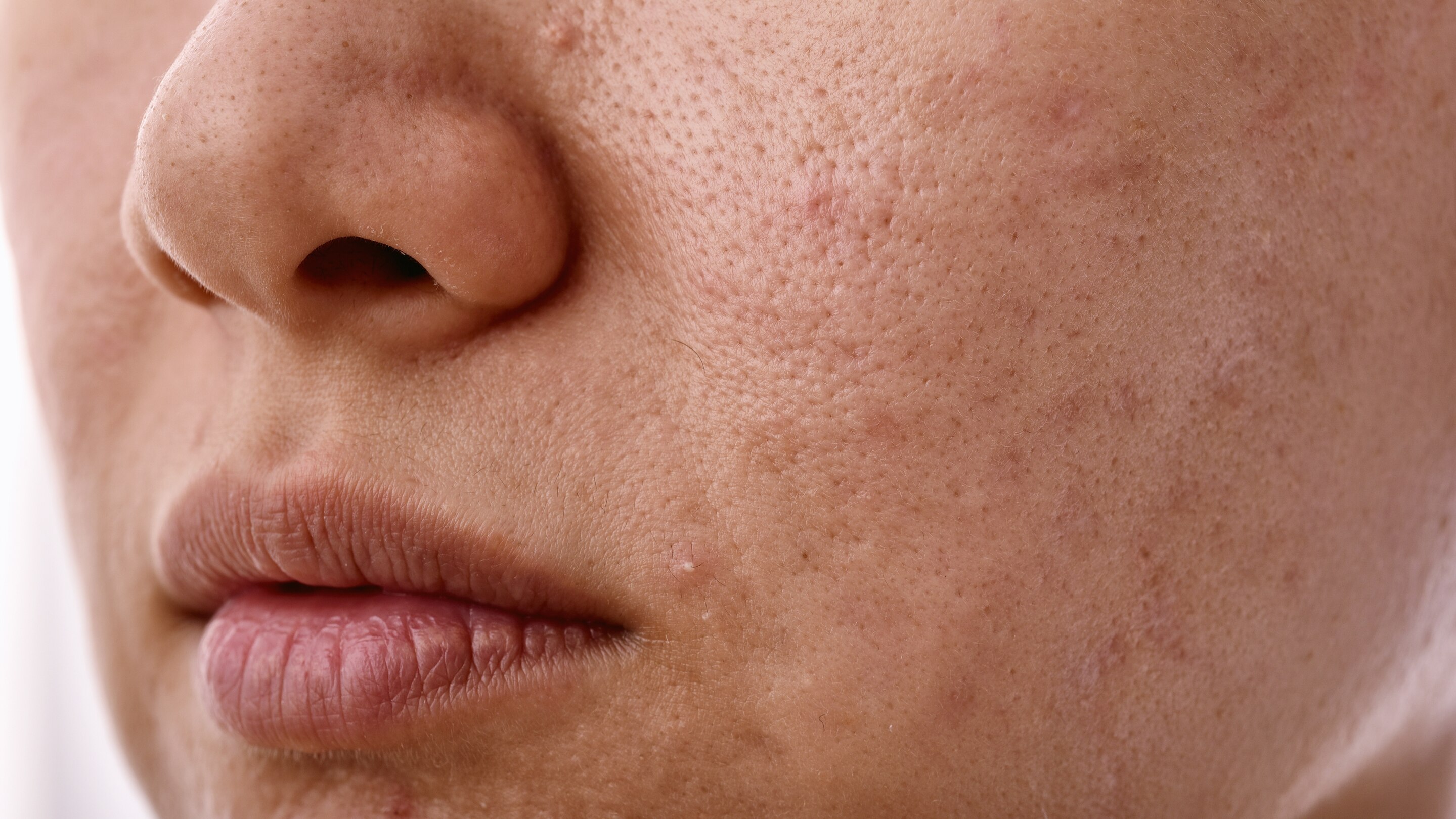 Fades Dark Spots