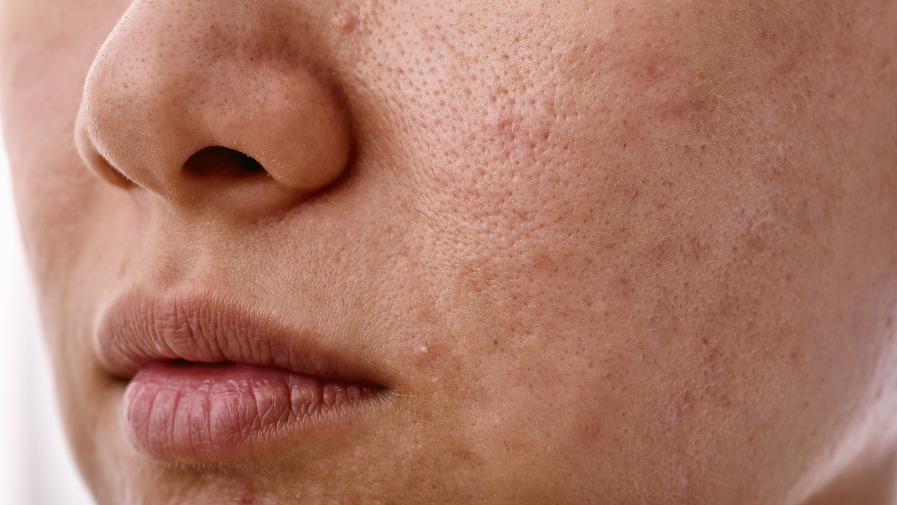 Fades Dark Spots