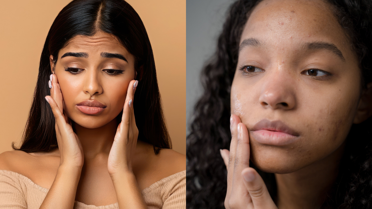 Dull Skin vs Uneven Skin Tone
