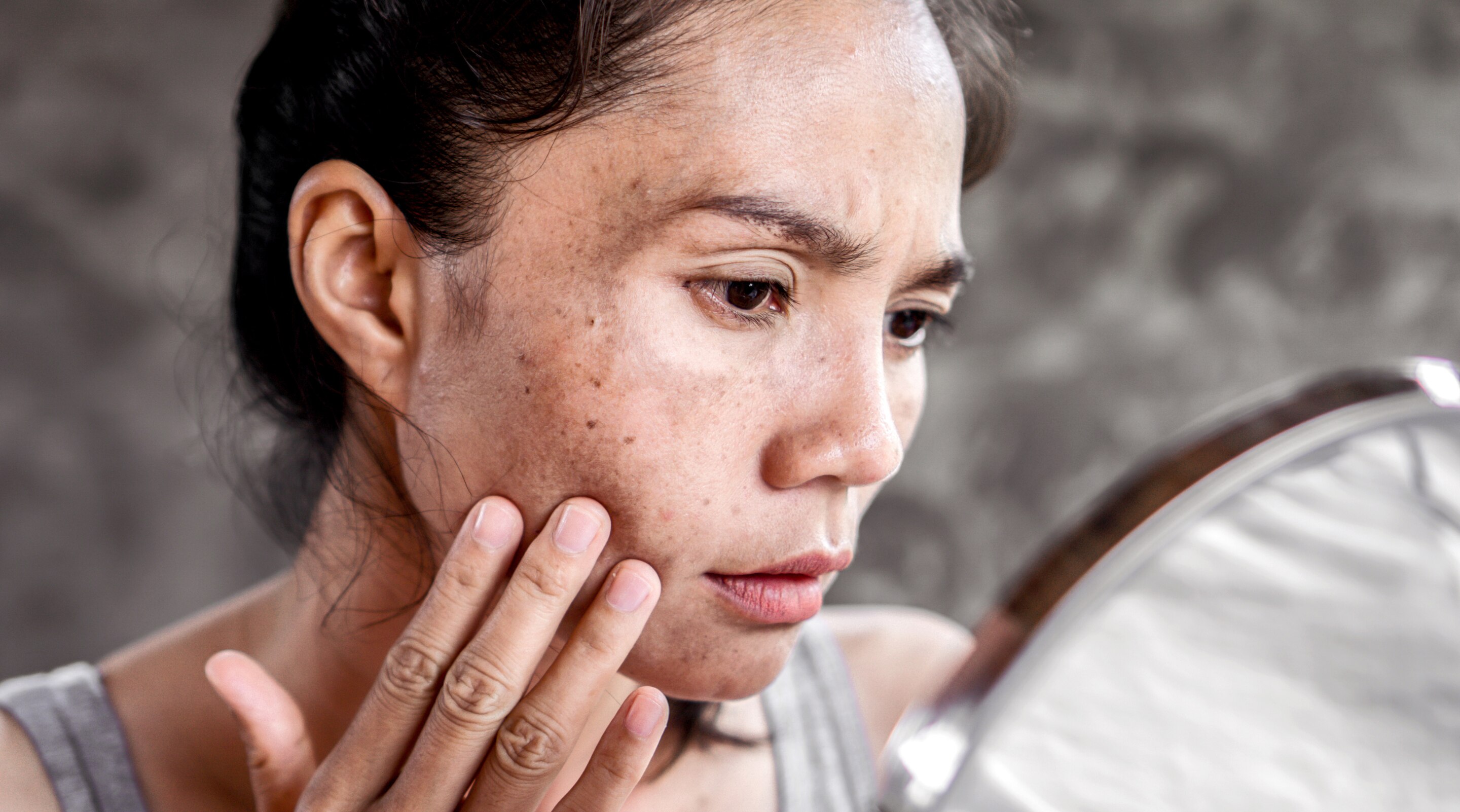 Dull Skin Causes and Treatment for Glowing Skin