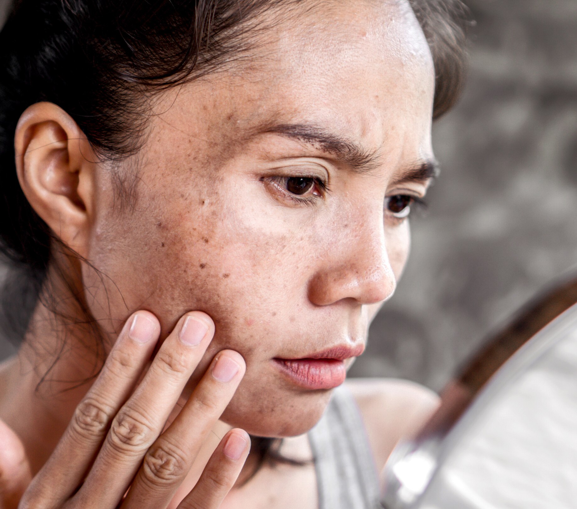 Image of Dull Skin: Causes, Treatment and How to Get Glowing Skin