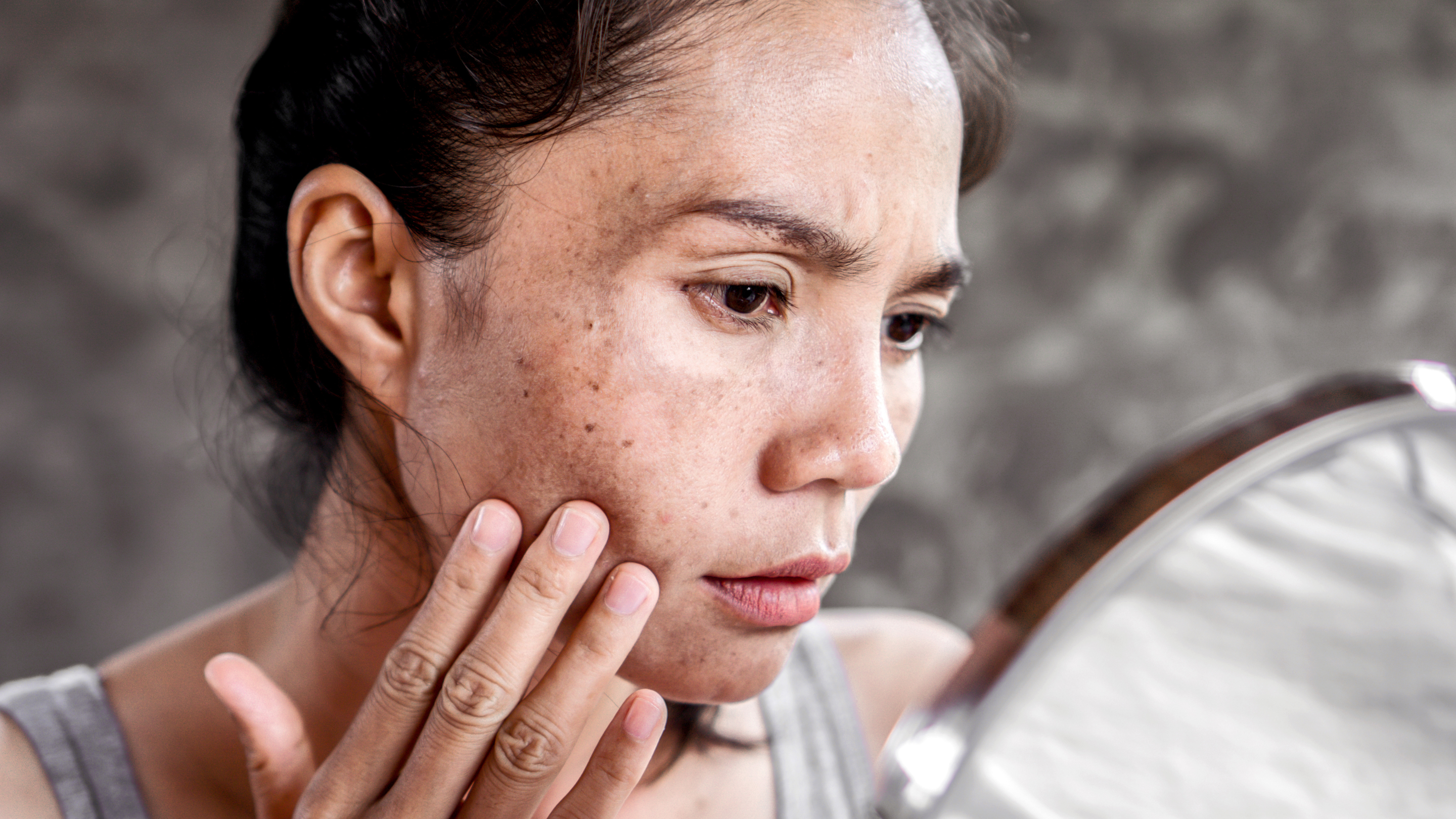 Dull Skin Causes and Treatment for Glowing Skin