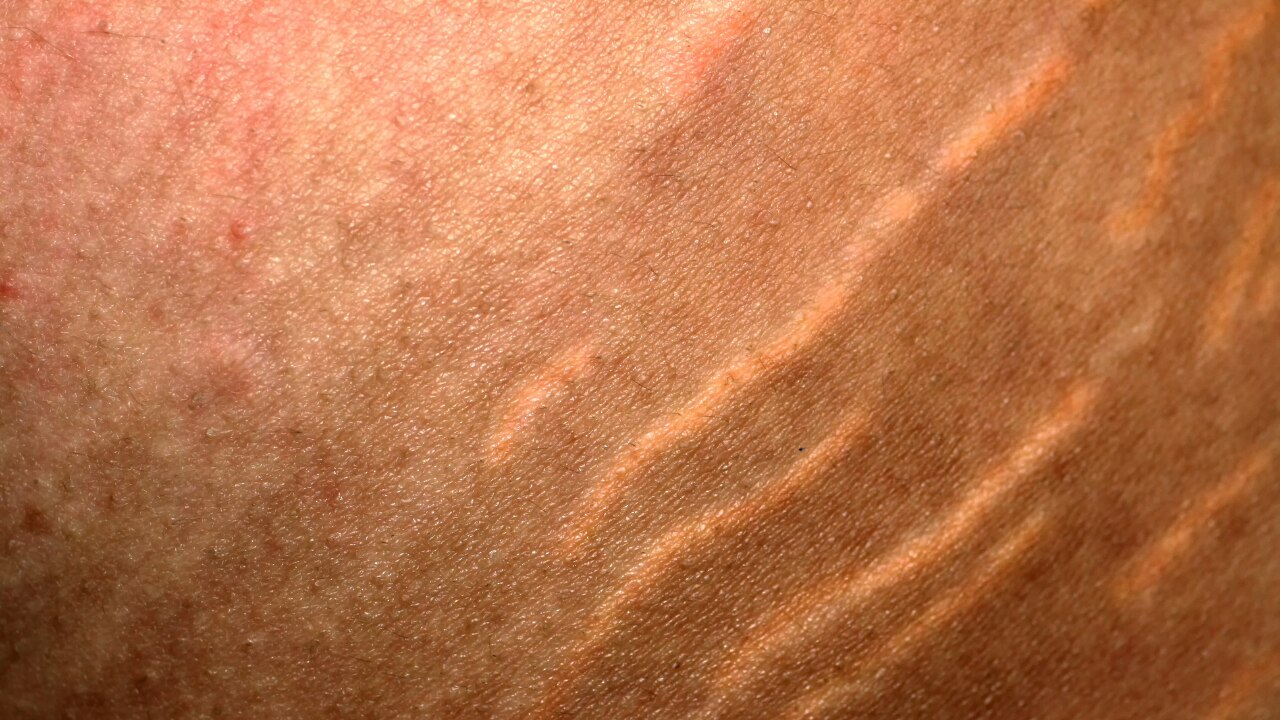 Purple or pink stretch marks