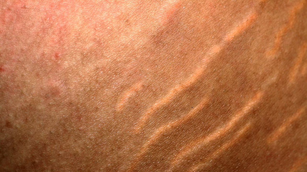 Purple or pink stretch marks
