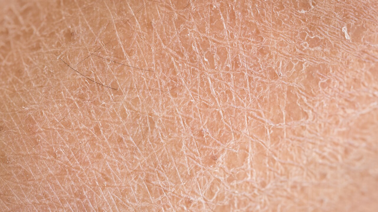 Thin, fragile skin