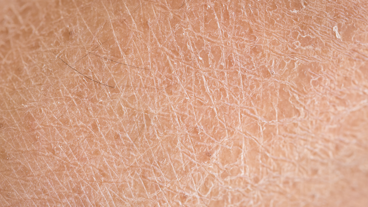 Thin, fragile skin
