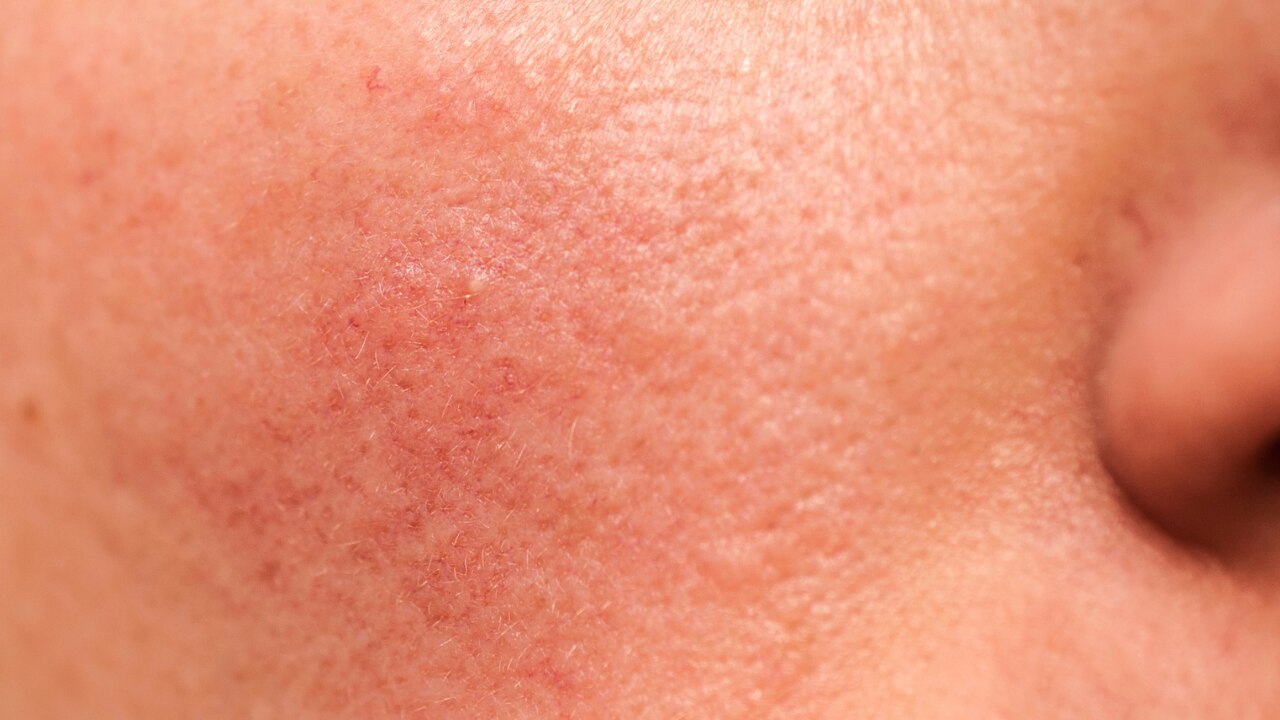 Combination Skin