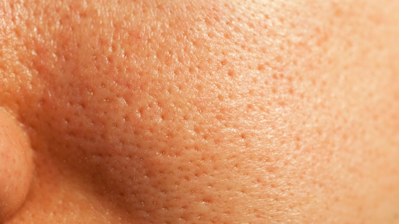 Enlarged, Congested Pores
