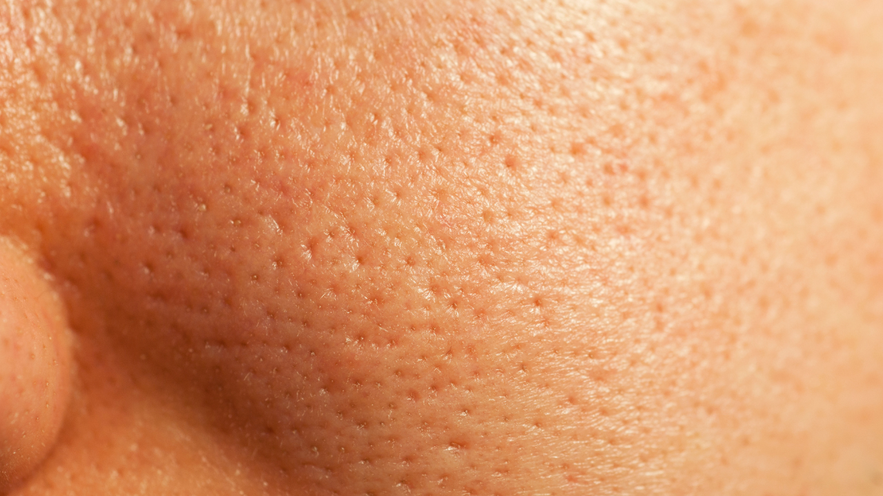 Enlarged, Congested Pores