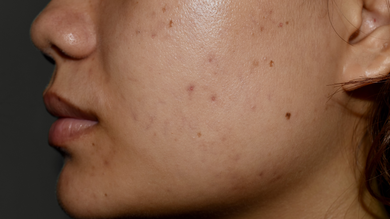 Post-Acne Marks and Pigmentation